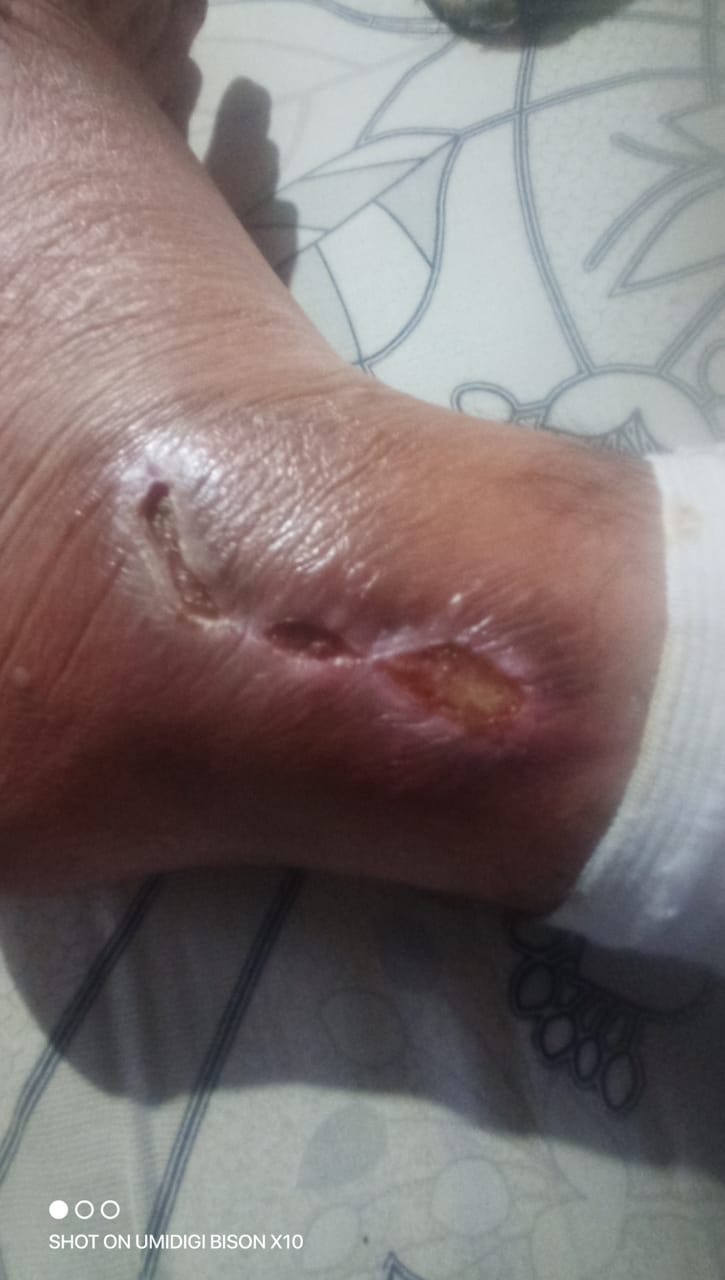 URGENT: Help me save my leg and my life campaign photo, 4 of 8