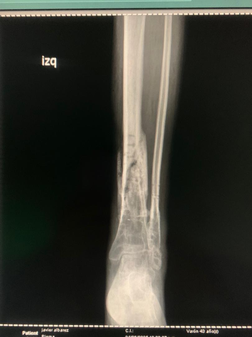 URGENT: Help me save my leg and my life campaign photo, 2 of 8
