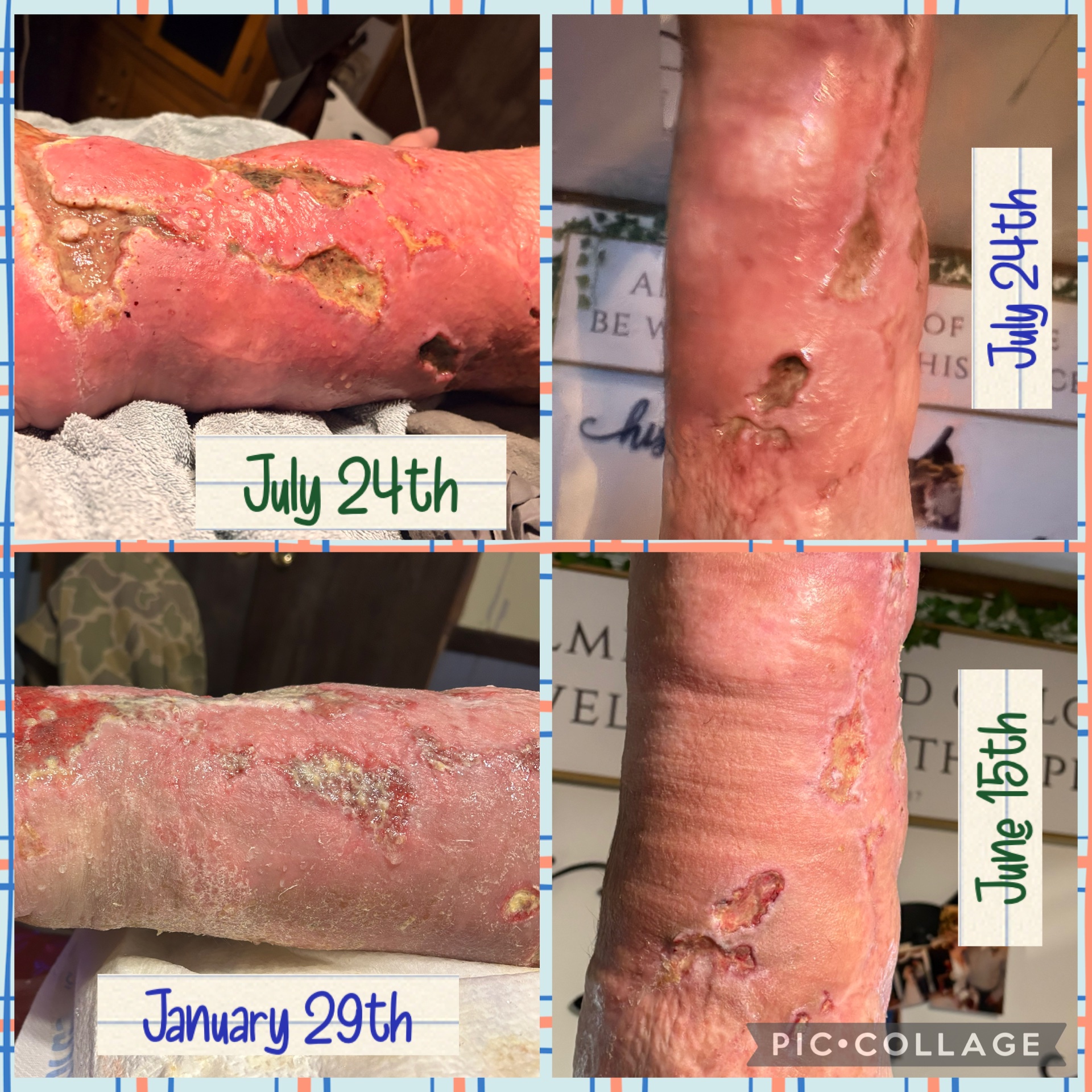 Help, Ben West as he becomes an amputee due to Vibrio! campaign photo, 6 of 8