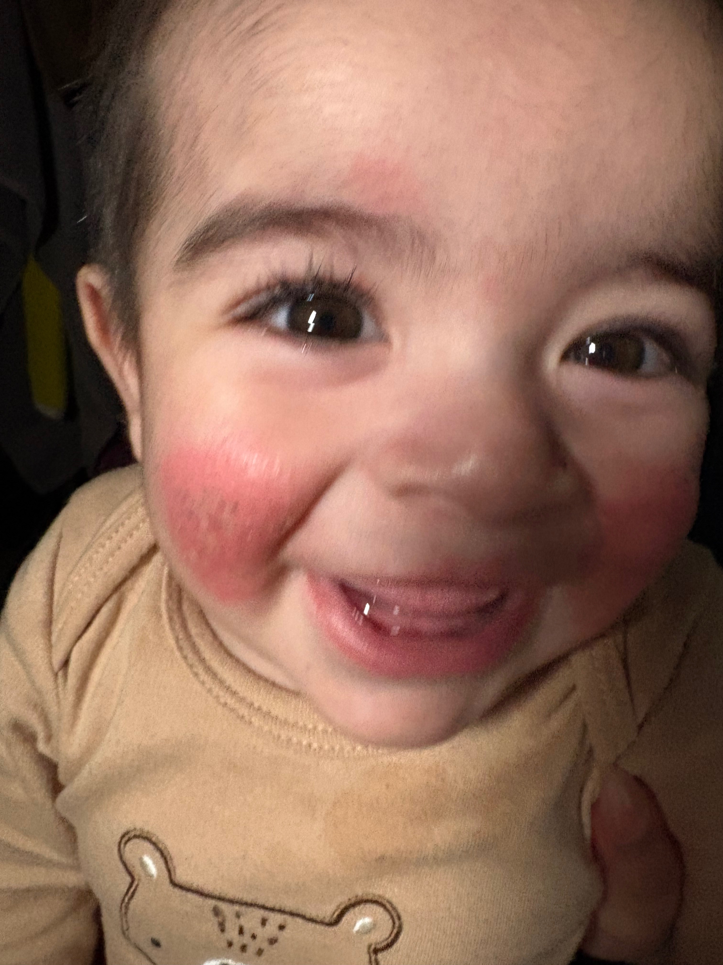 help get my baby an eczema treatment campaign photo, 2 of 6