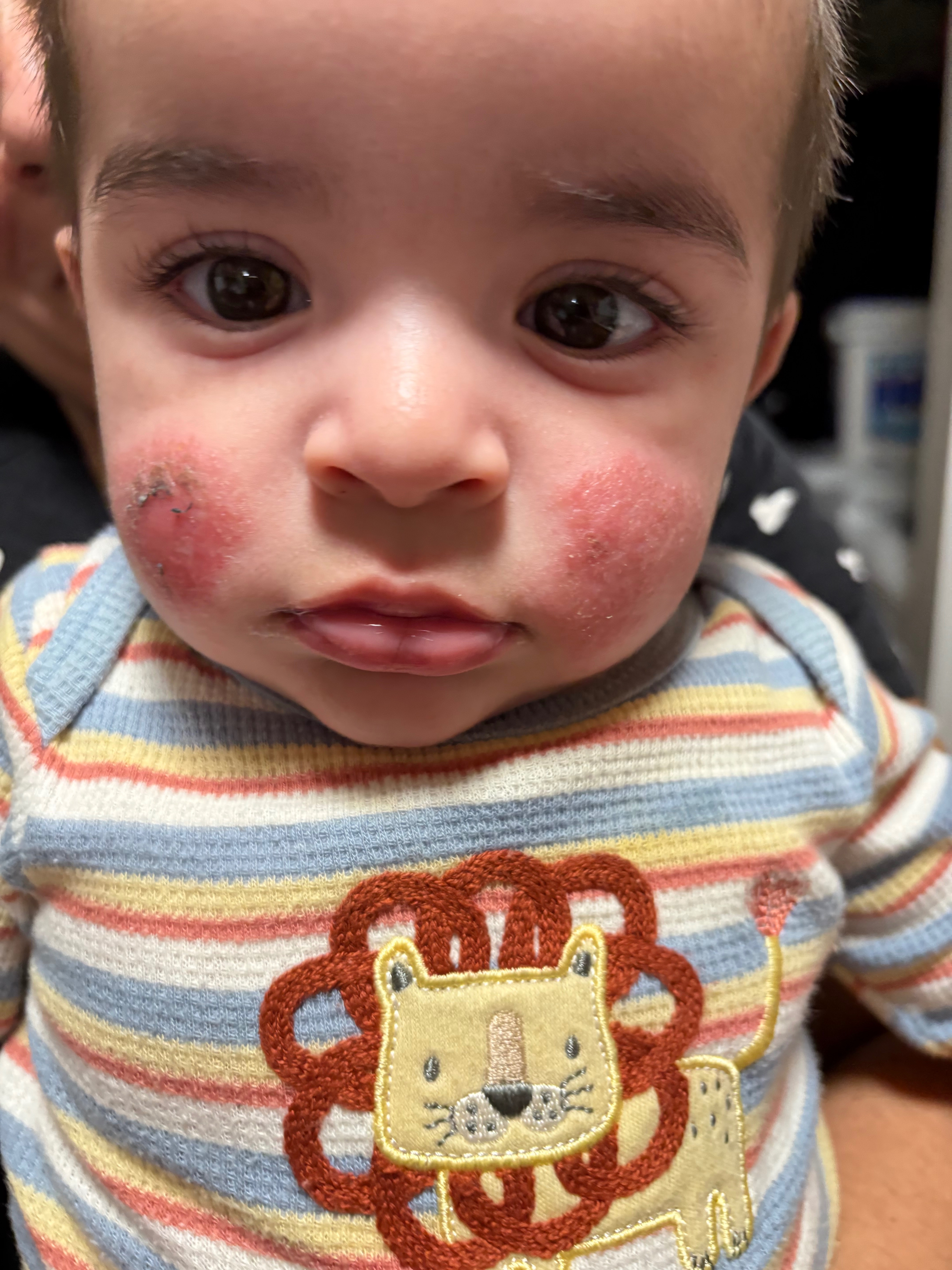 help get my baby an eczema treatment campaign photo, 4 of 6