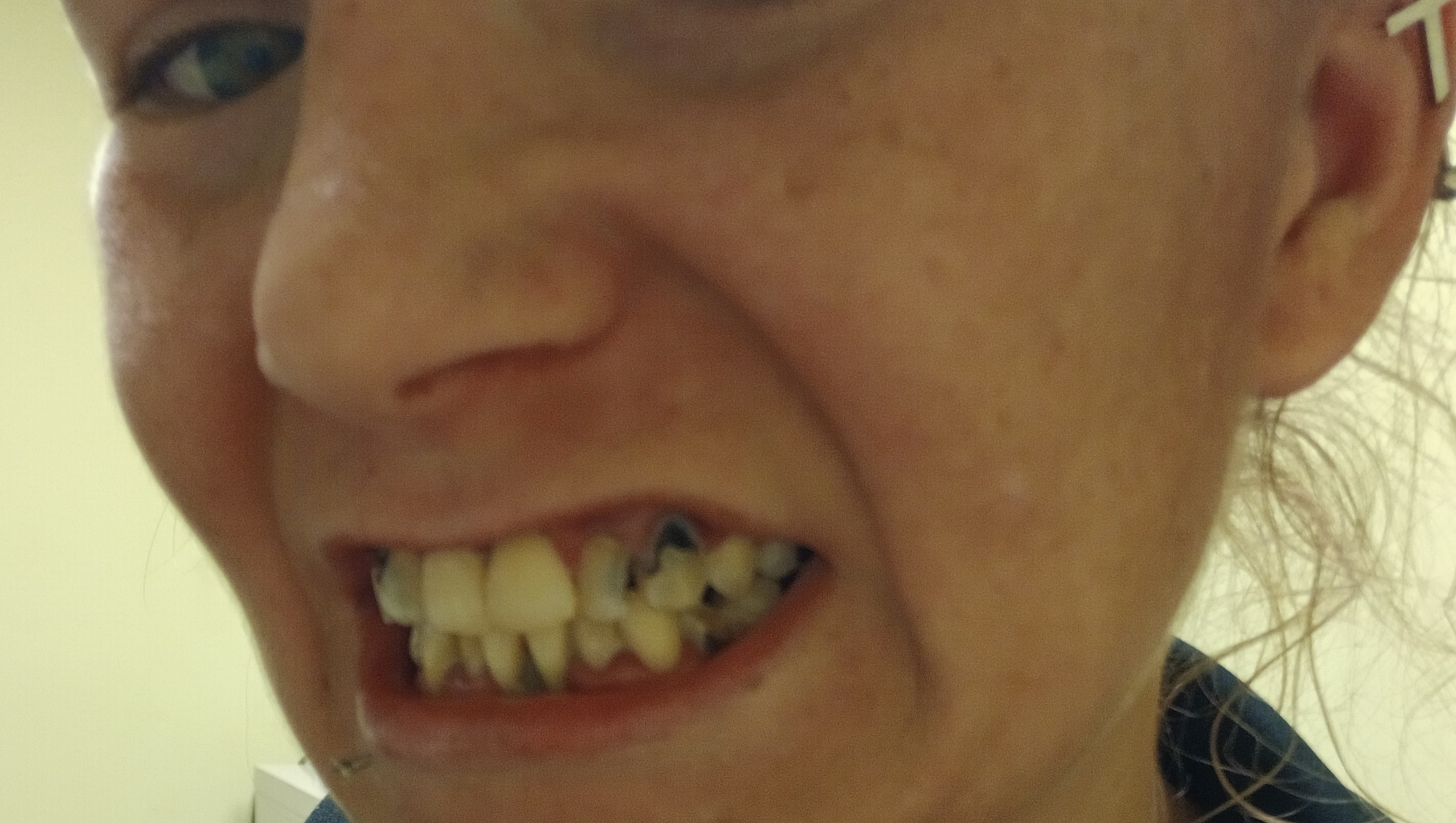 Help Brooke Smile Again: Support for Dentures foto