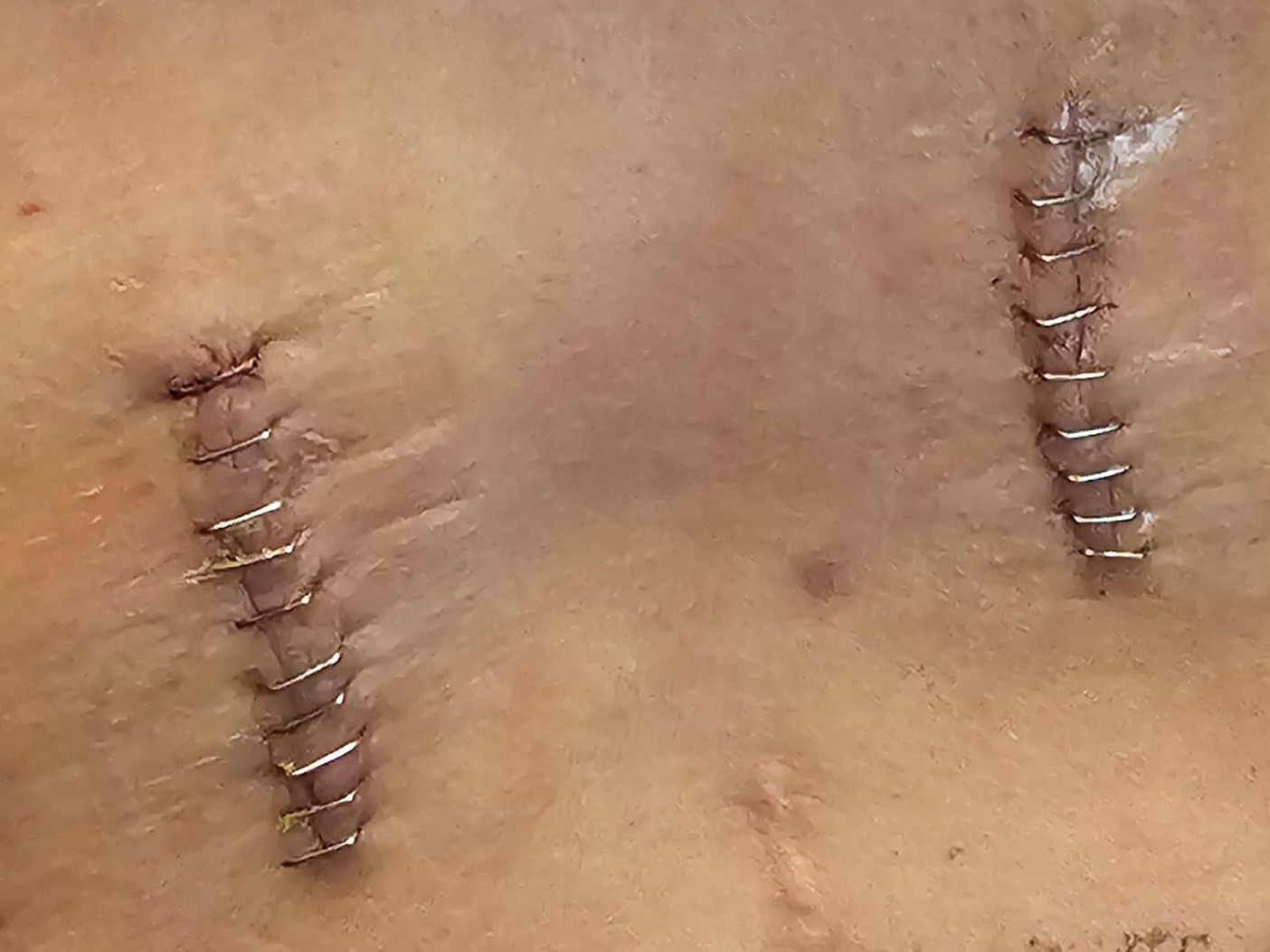 Support Melissa After Several Surgeries & Complications campaign photo, 7 of 8