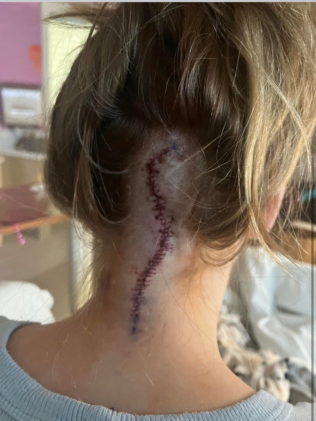 Nellys Journey With Epilepsy campaign photo, 5 of 7