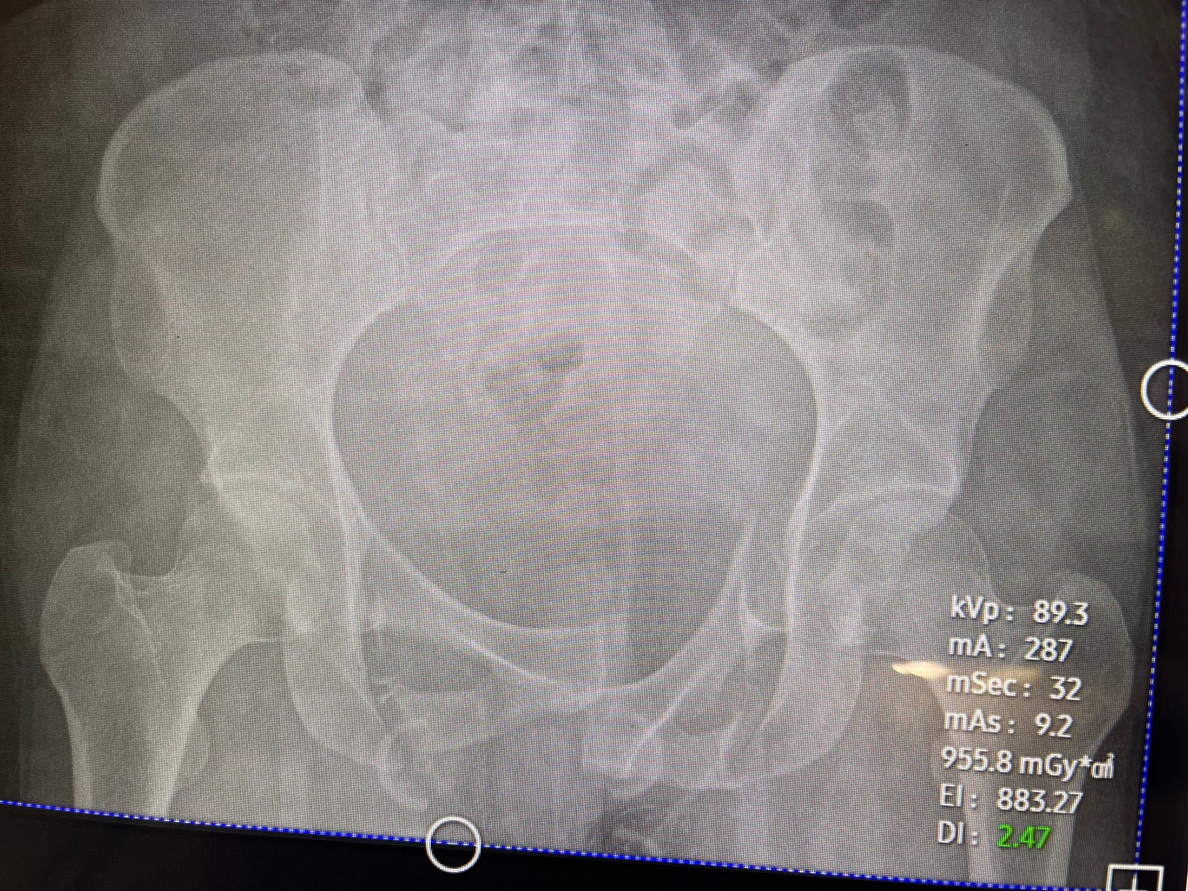 “Standing Strong Again: Kayla’s Pelvic Break Recovery Fund” campaign photo, 6 of 8