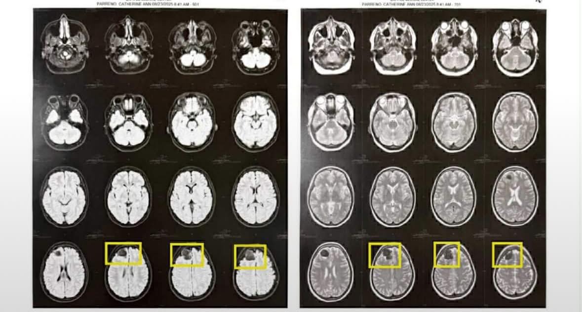 Help Cate Get Urgent Brain Surgery campaign photo, 2 of 4