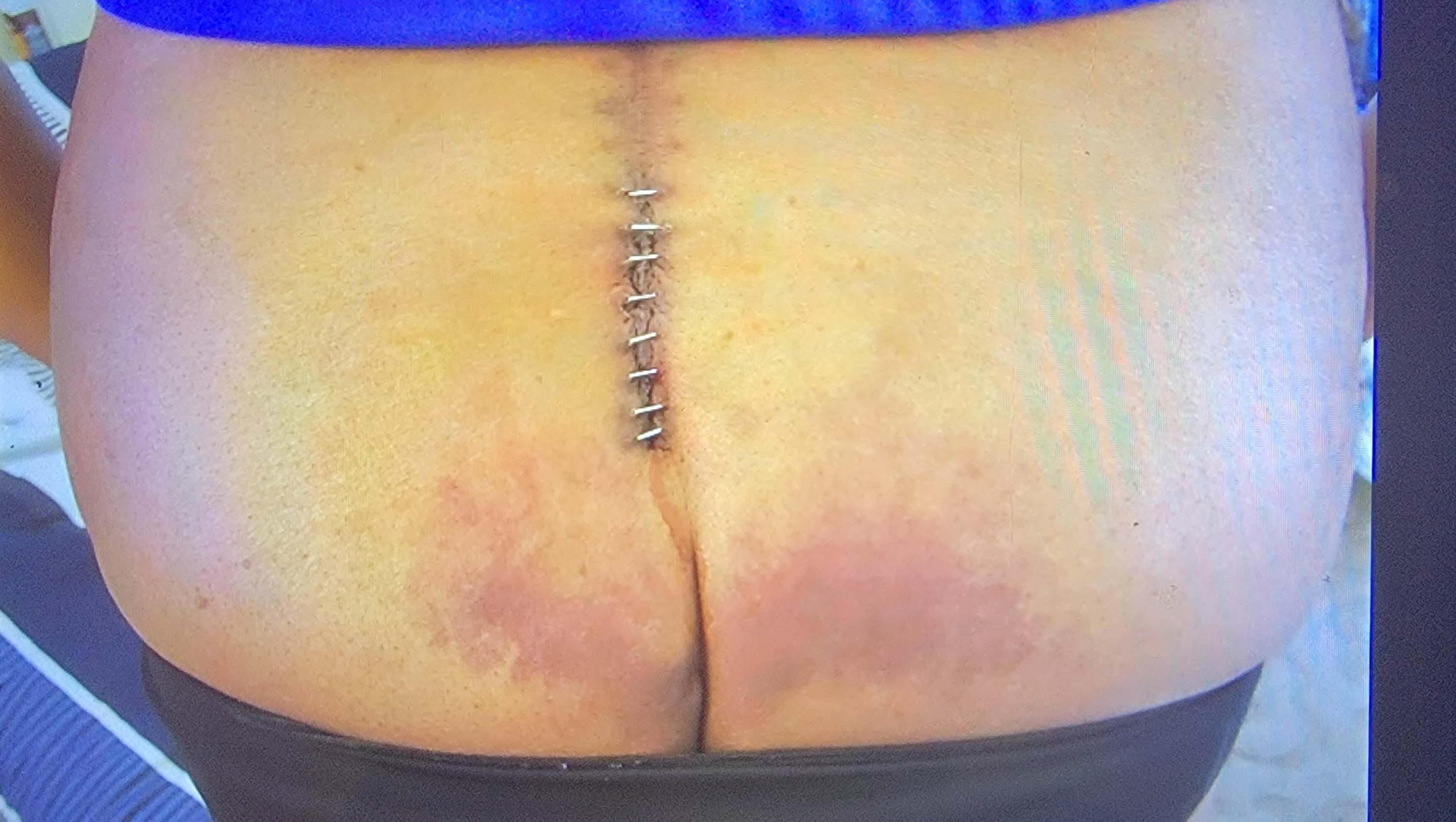 Back Surgery photo