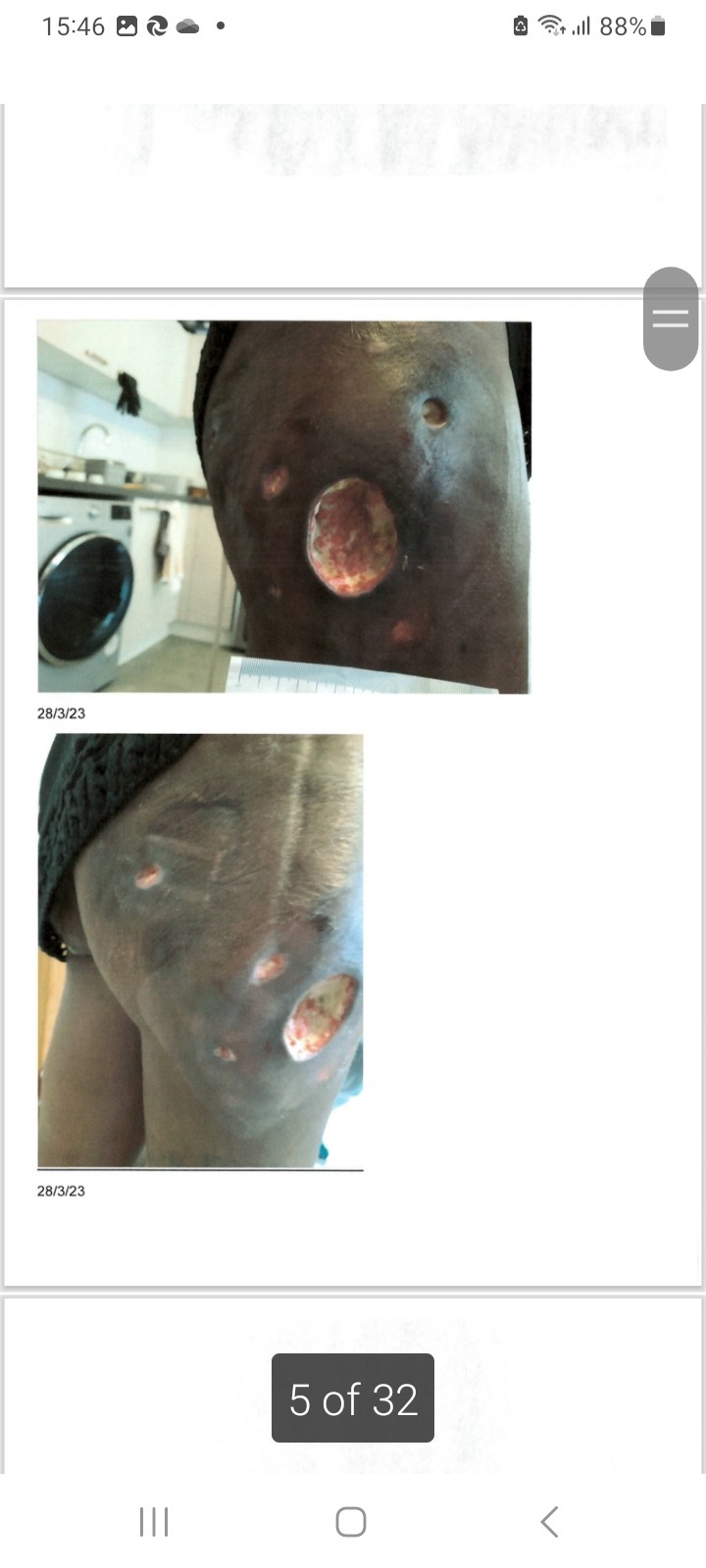 Help us raise money for my mother’s correctional surgery campaign photo, 5 of 8