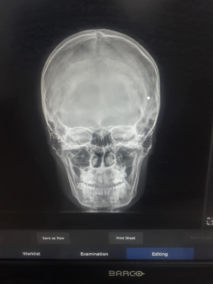Help me get the shrapnel out of my head and achieve my dre campaign photo, 2 of 4