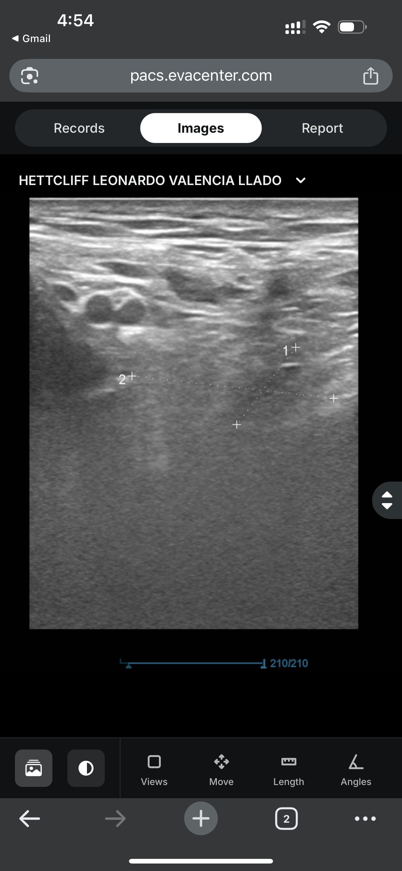 To help me for an inguinal hernia surgery campaign photo, 2 of 8