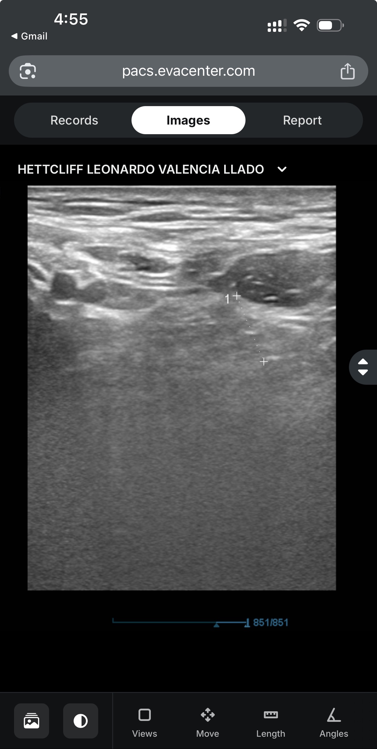 To help me for an inguinal hernia surgery campaign photo, 4 of 8
