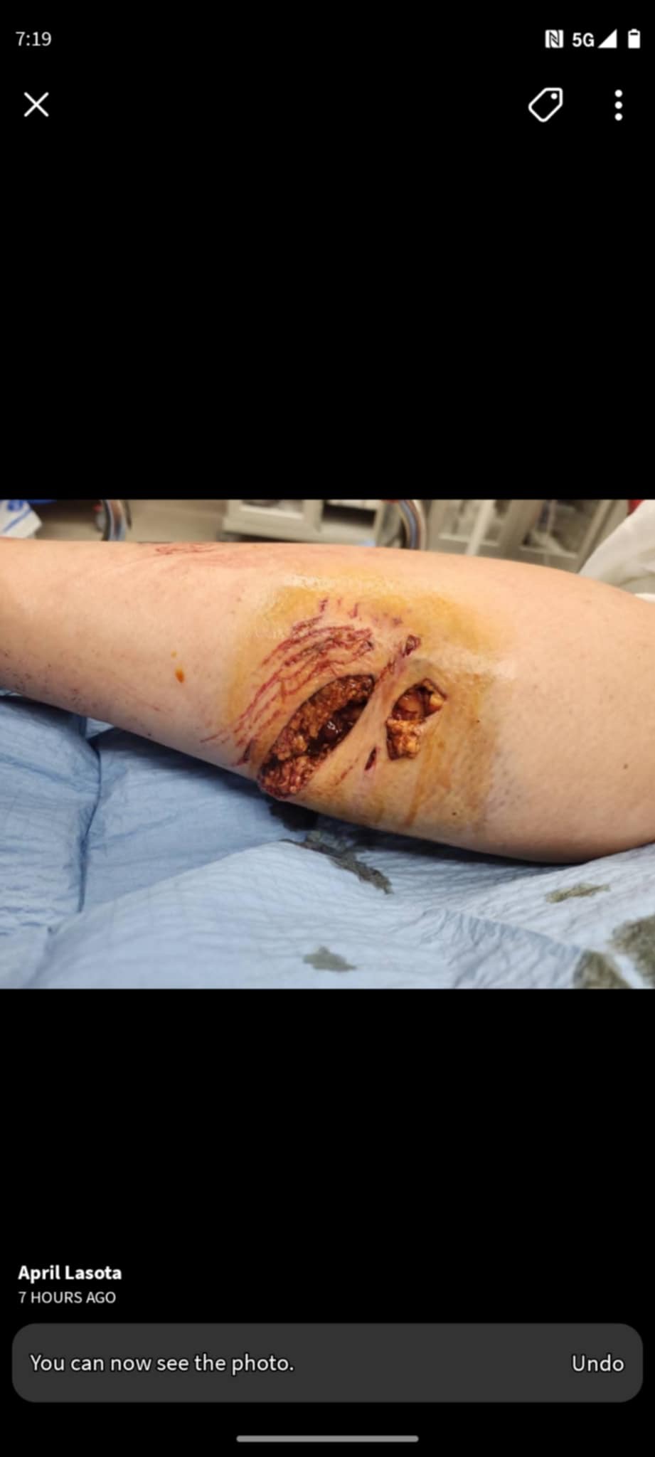 Severe dog attack campaign photo, 2 of 8