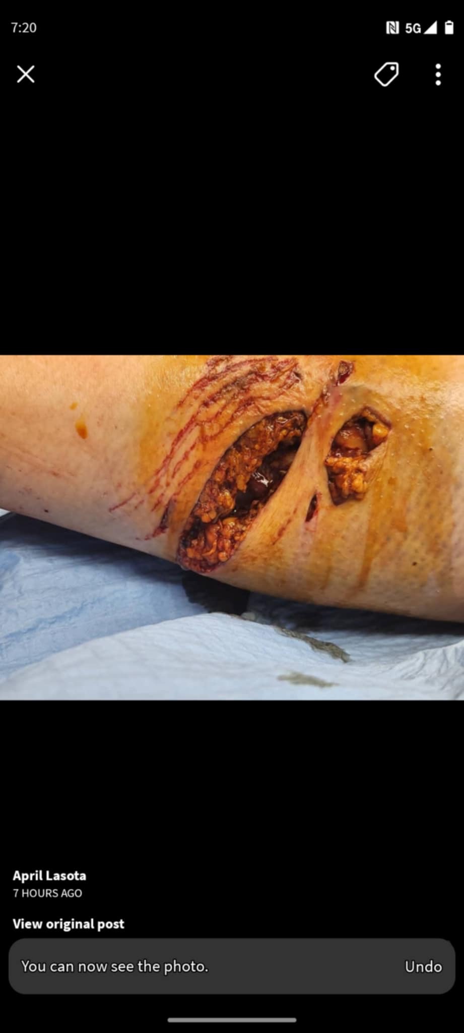 Severe dog attack campaign photo, 7 of 8
