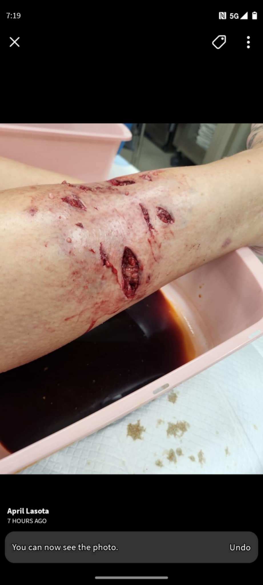Severe dog attack campaign photo, 6 of 8