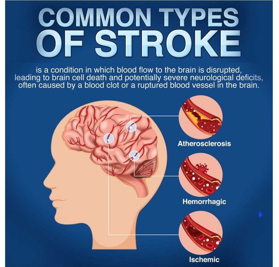 I had a stroke campaign photo, 2 of 4