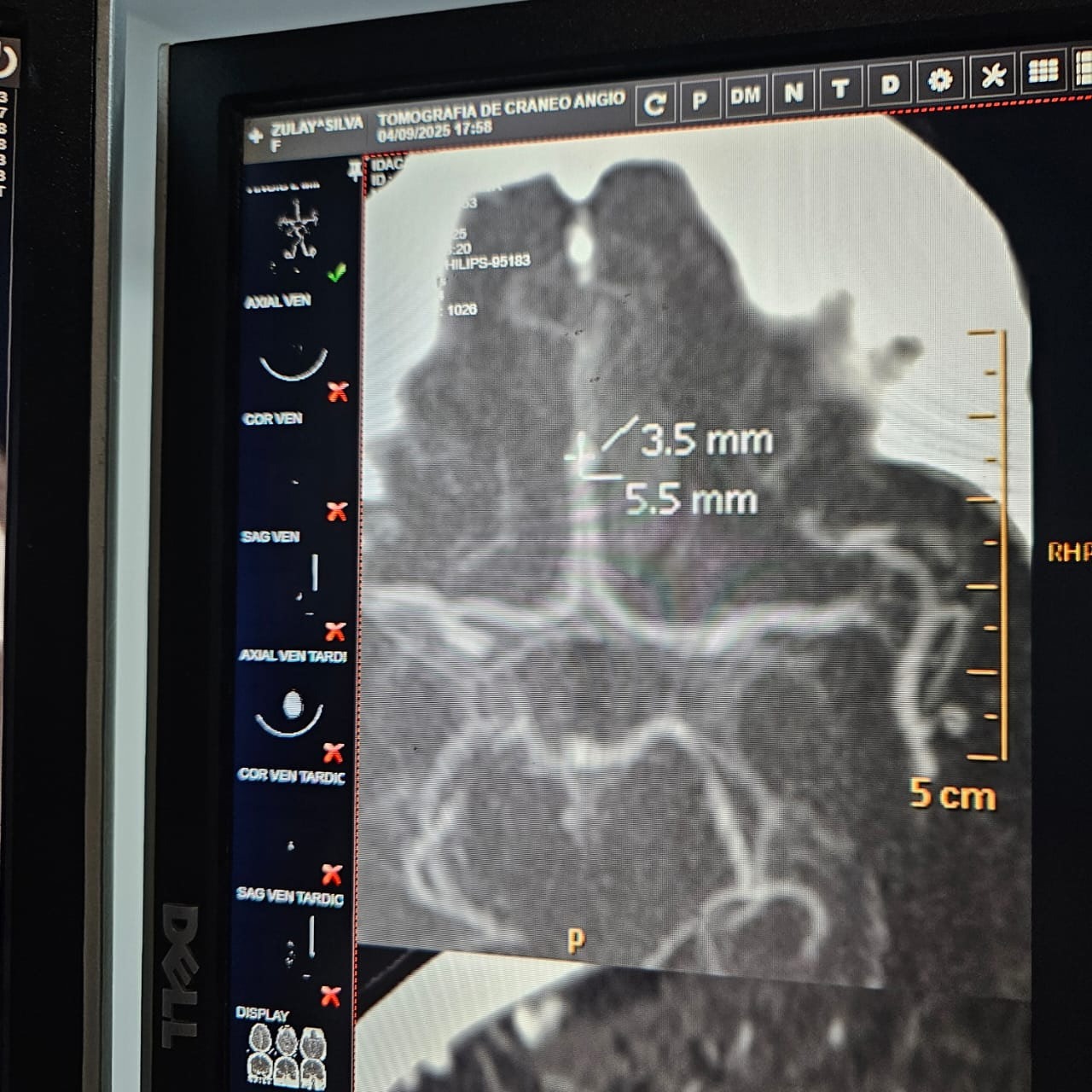 Help My Mom Get Life-Saving Surgery After a Stroke campaign photo, 2 of 8