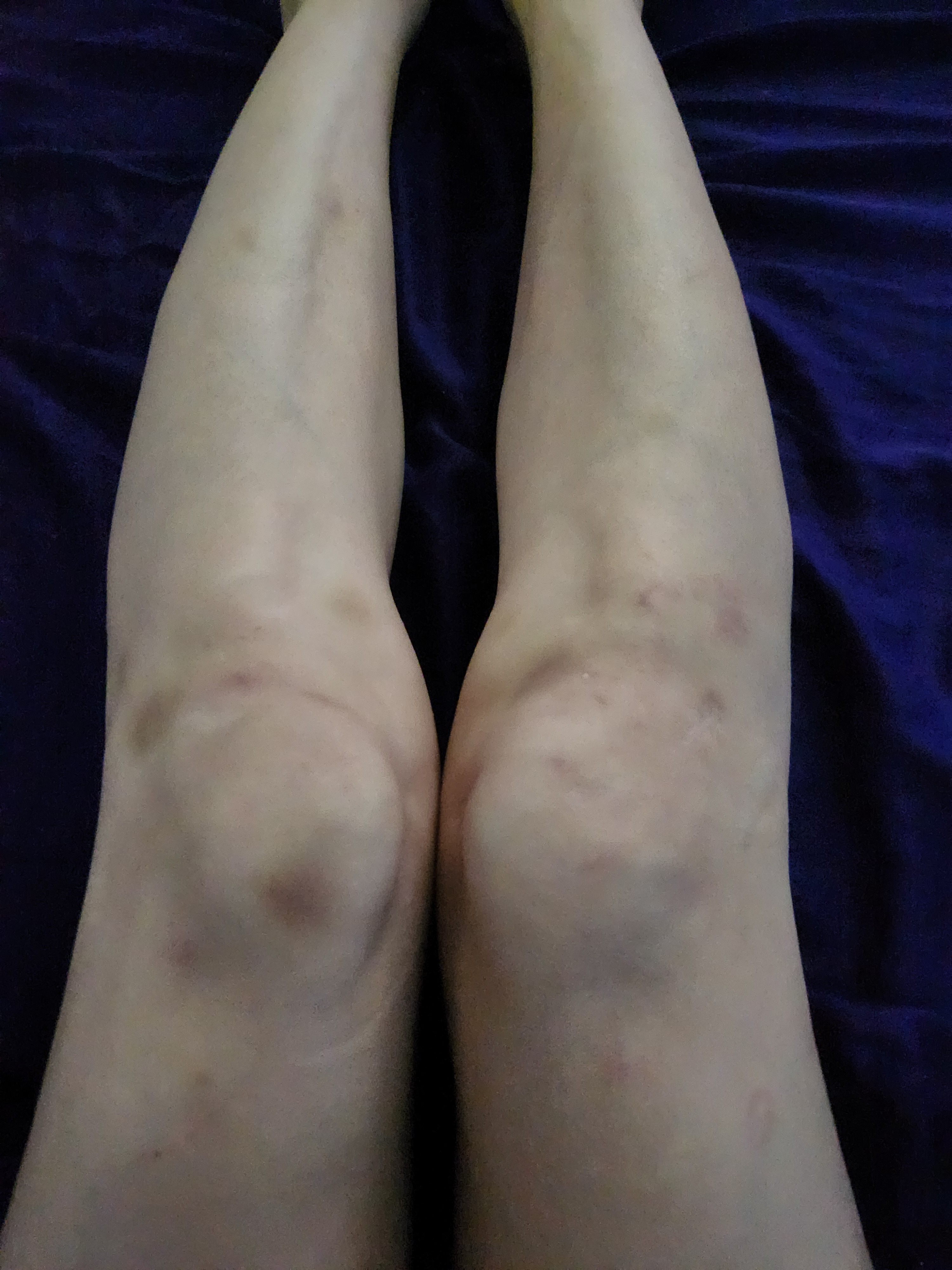 Help Christina Get Vital Epilepsy Treatment campaign photo, 4 of 8