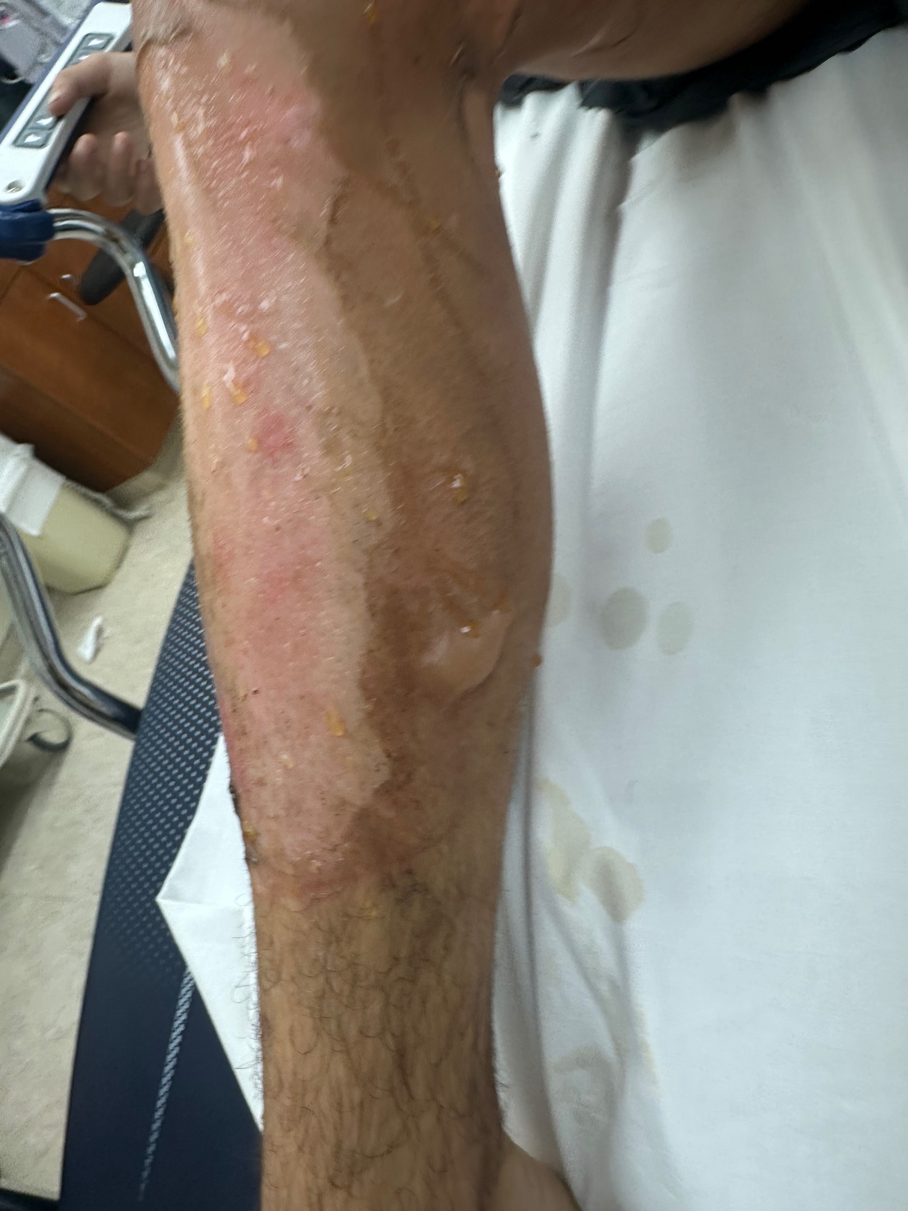 Support Christian's Recovery from Severe Burns campaign photo, 5 of 6