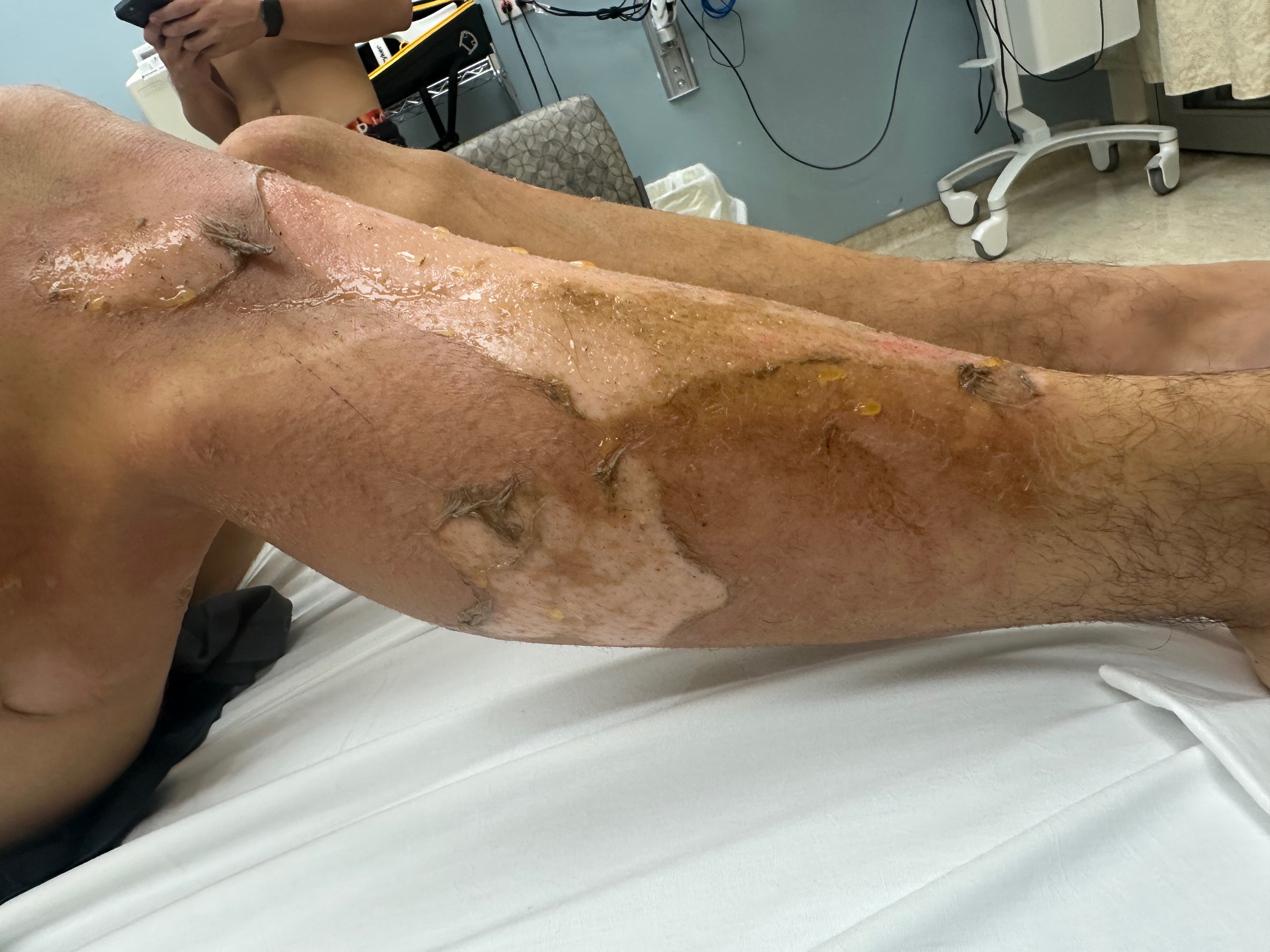 Support Christian's Recovery from Severe Burns campaign photo, 2 of 6