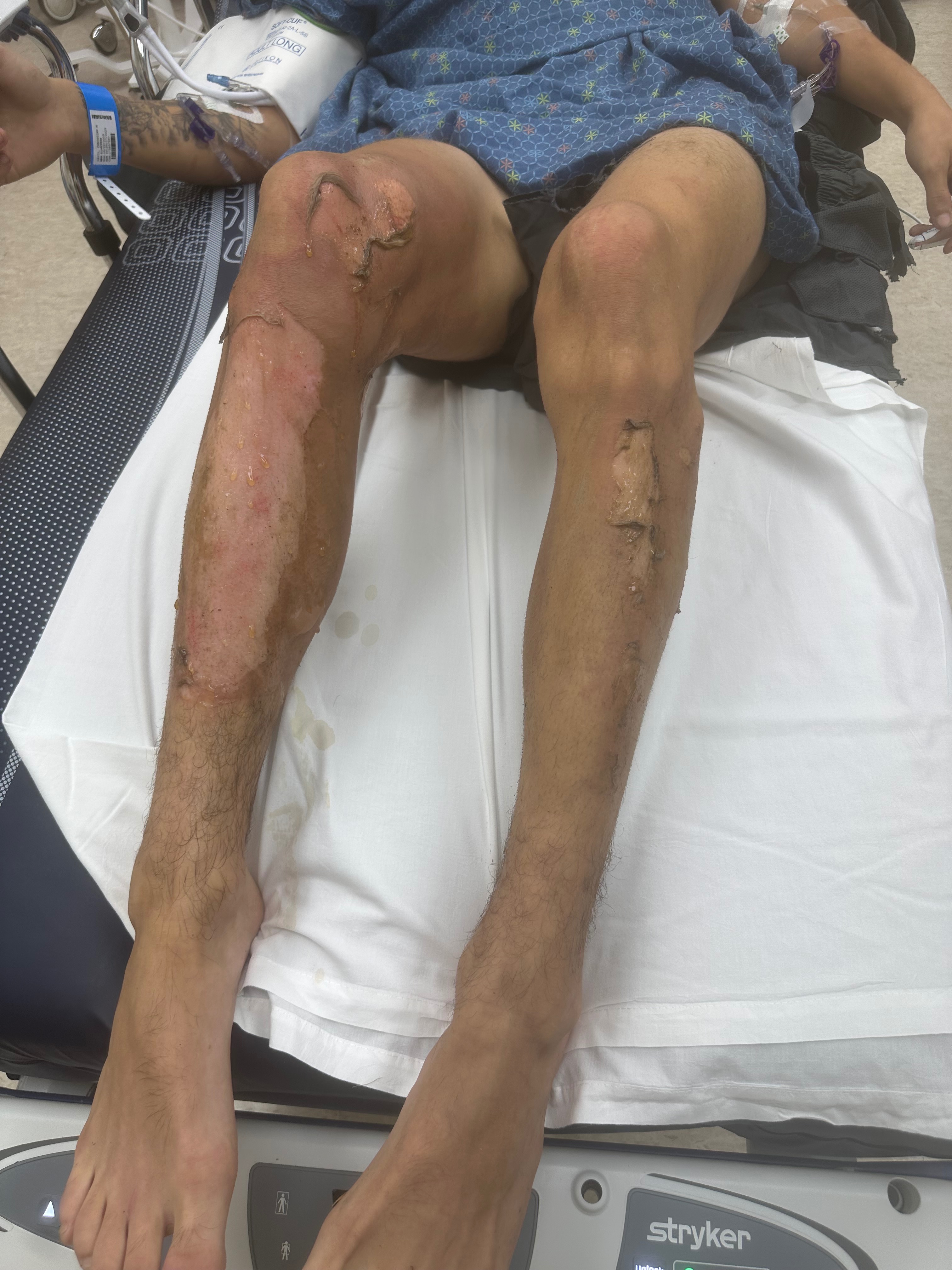 Support Christian's Recovery from Severe Burns campaign photo, 4 of 6