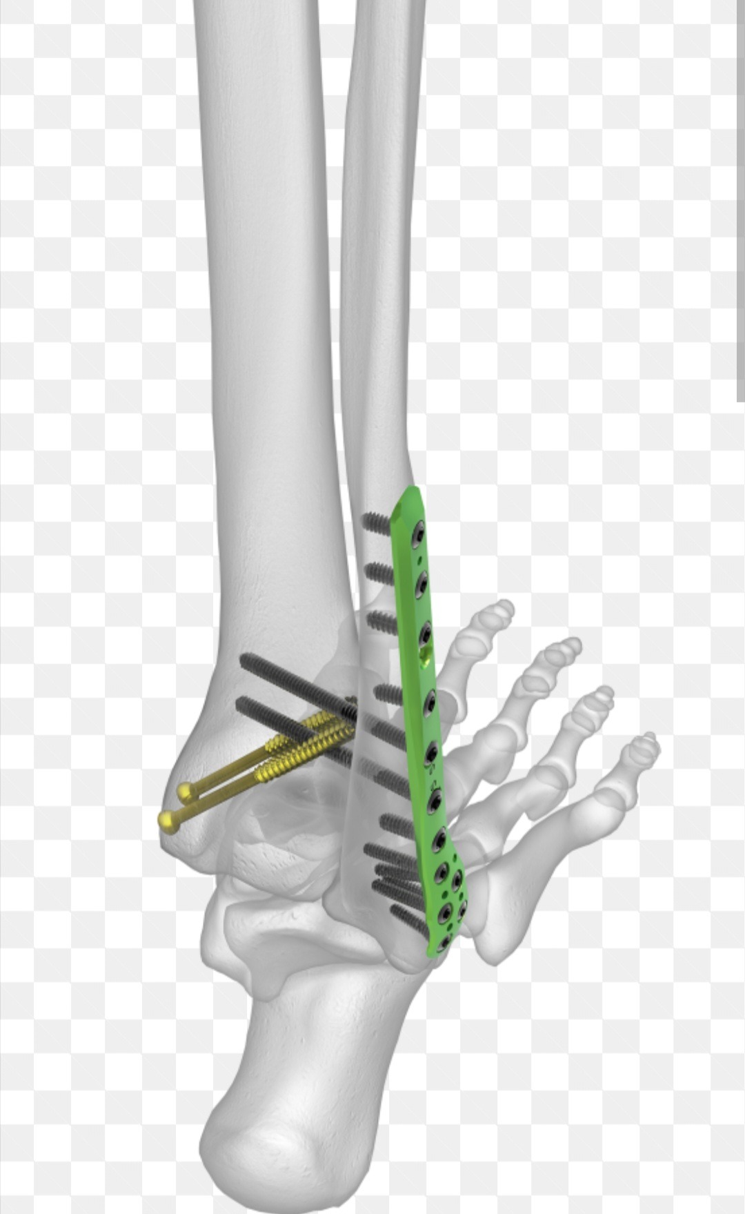 Help support Katie for ankle surgery and recovery campaign photo, 2 of 6