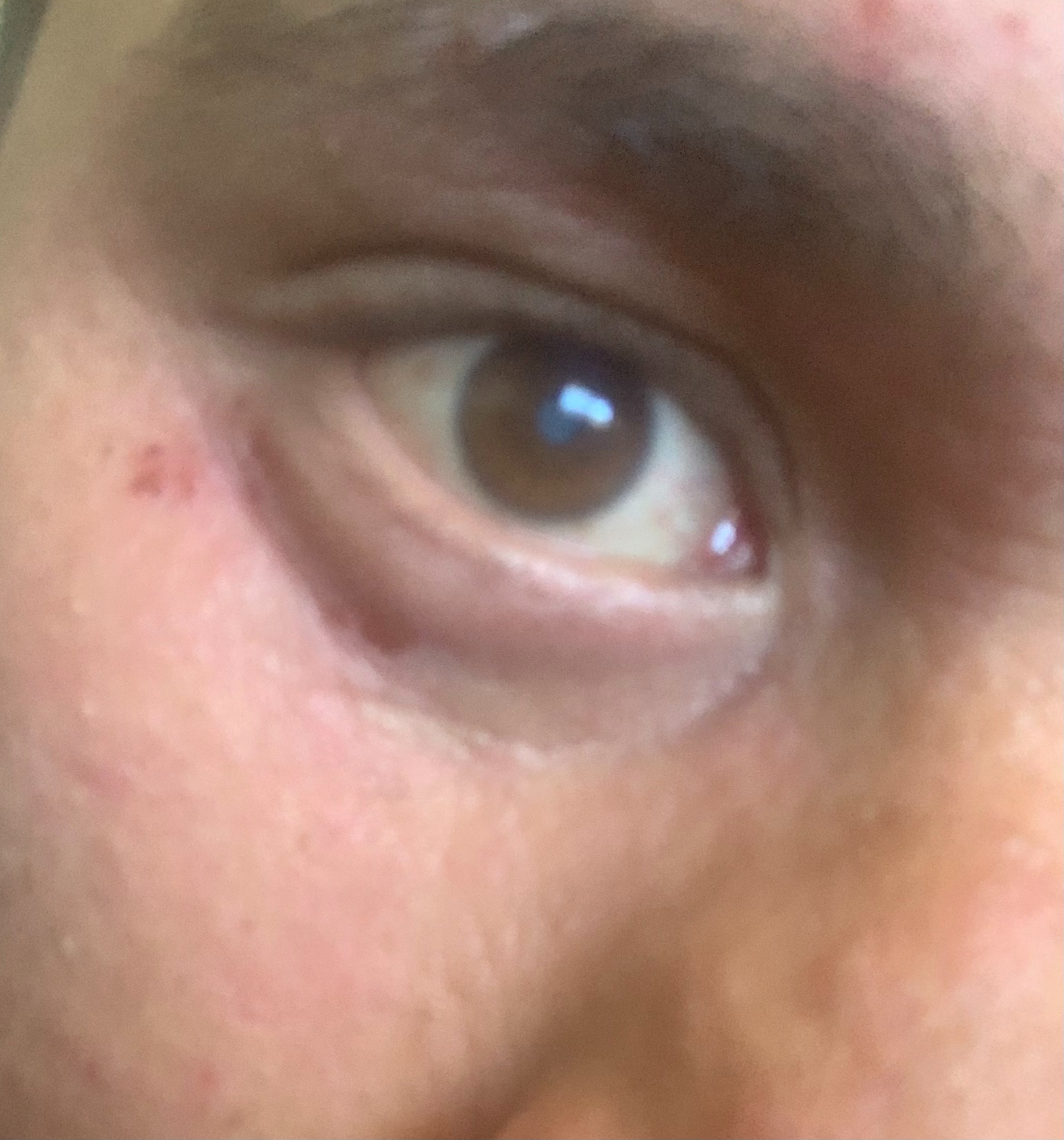 donate to help me pay for eye surgery campaign photo, 2 of 6