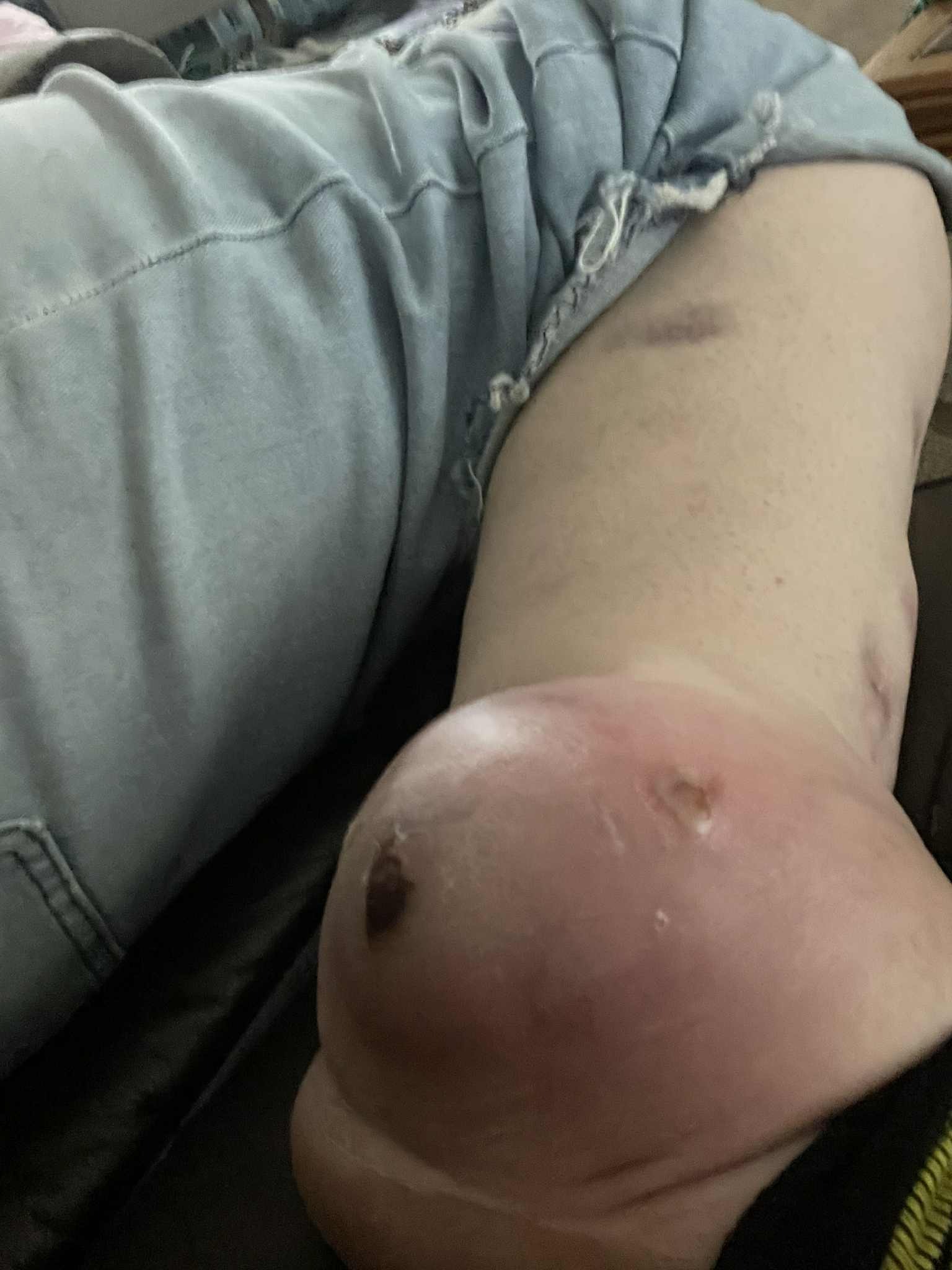 Amputation surgery campaign photo, 2 of 6