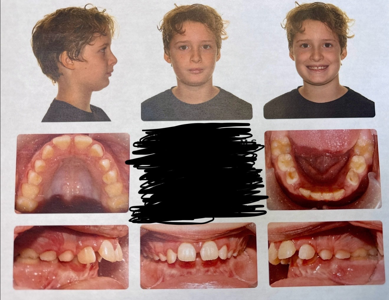 Rowan’s Orthodontic Journey! campaign photo, 5 of 7