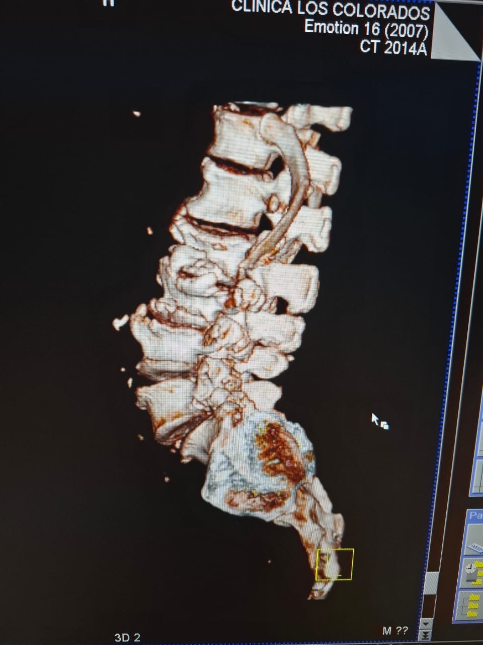 Urgent Surgery for Leonardo's Spine Recovery campaign photo, 7 of 8