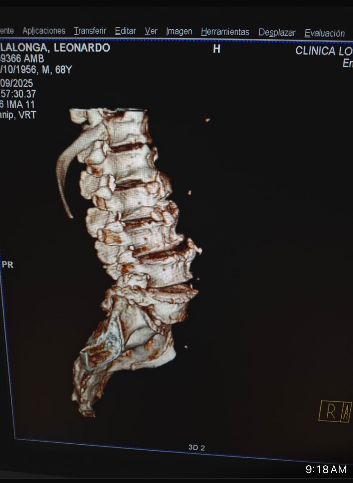 Urgent Surgery for Leonardo's Spine Recovery campaign photo, 2 of 8