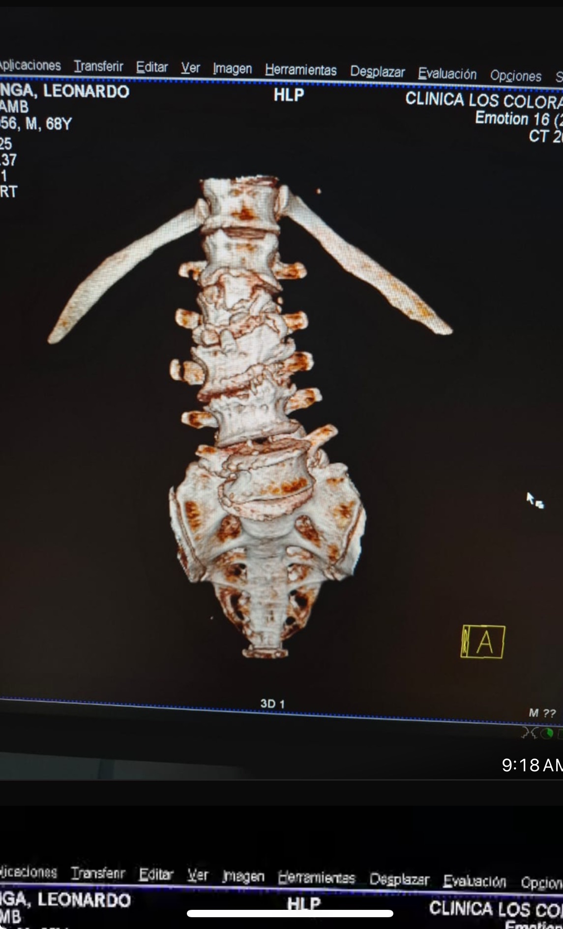 Urgent Surgery for Leonardo's Spine Recovery campaign photo, 4 of 8