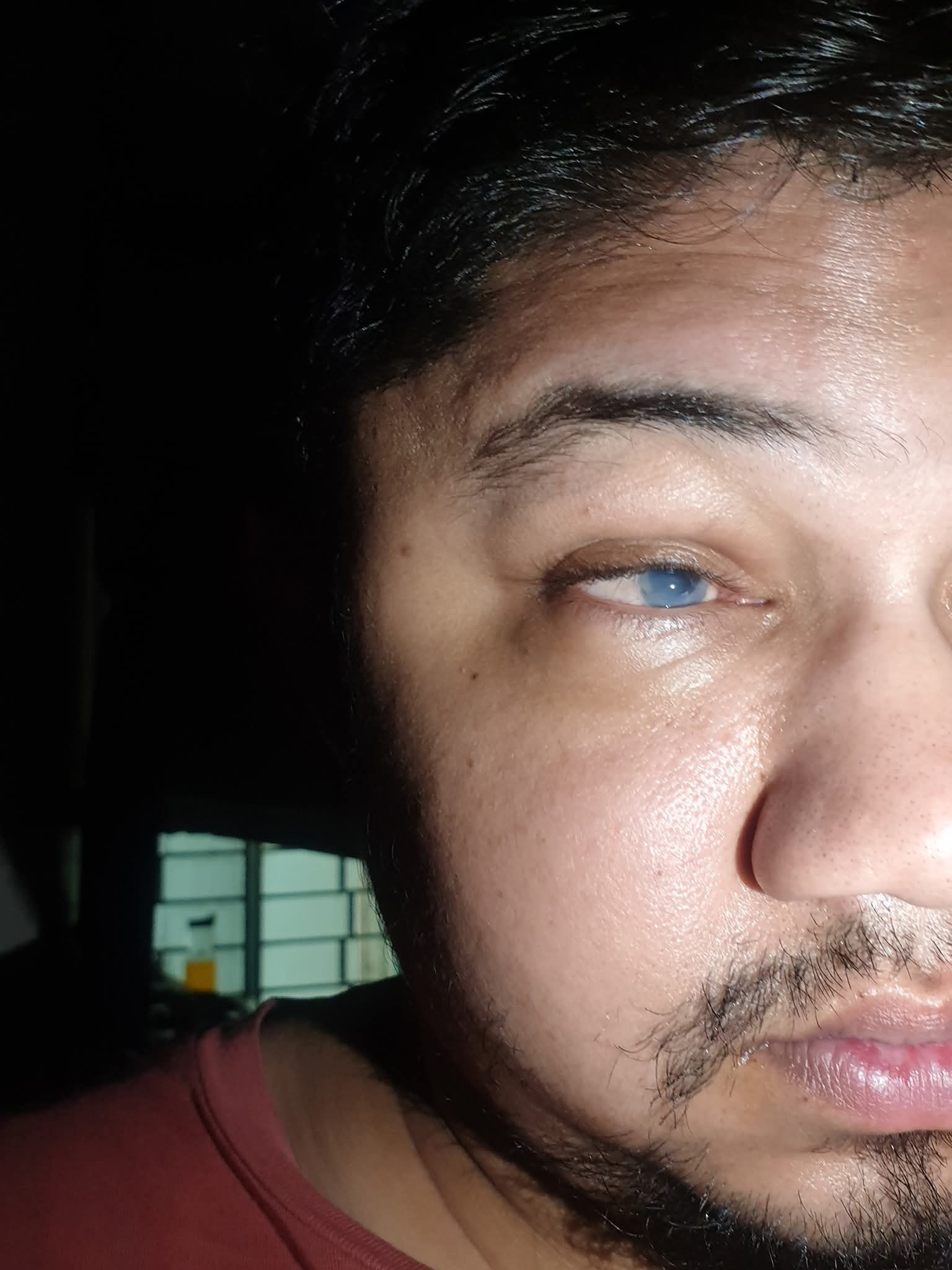 Please Help Me Save My Vision After a Medical Accident campaign photo, 6 of 8