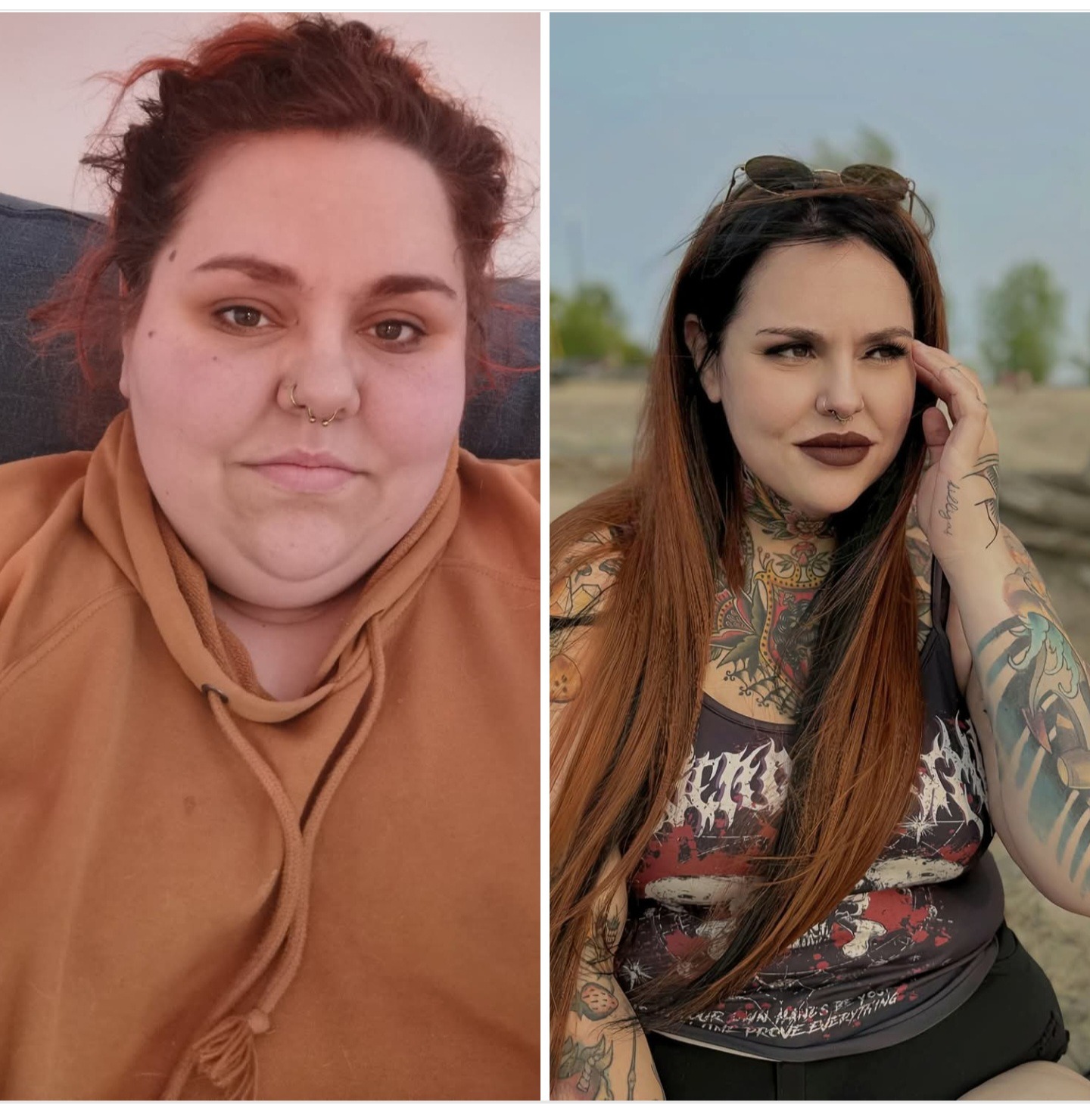 The last step of my weight loss journey.. Skin removal! campaign photo, 6 of 7