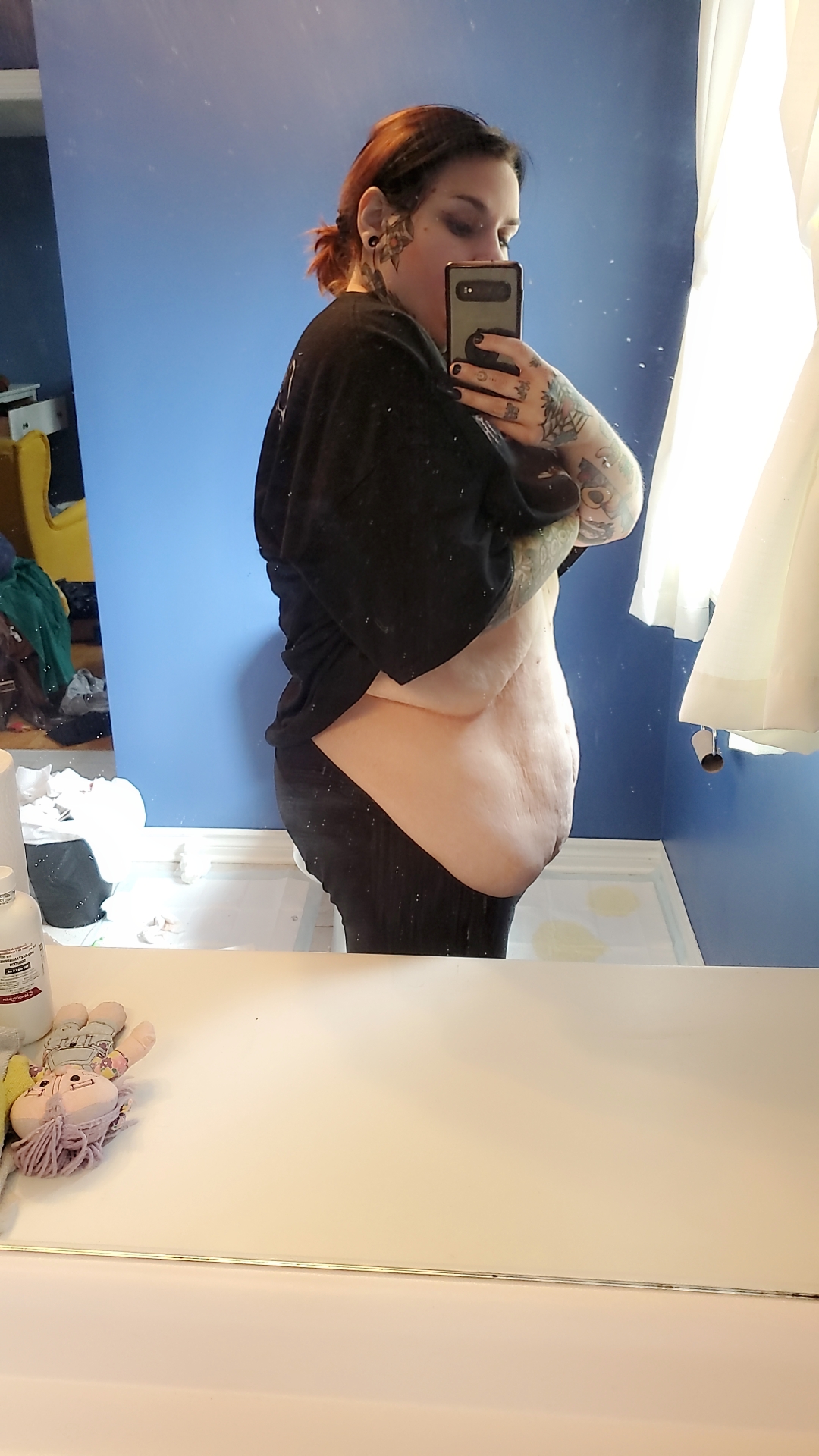The last step of my weight loss journey.. Skin removal! campaign photo, 5 of 7