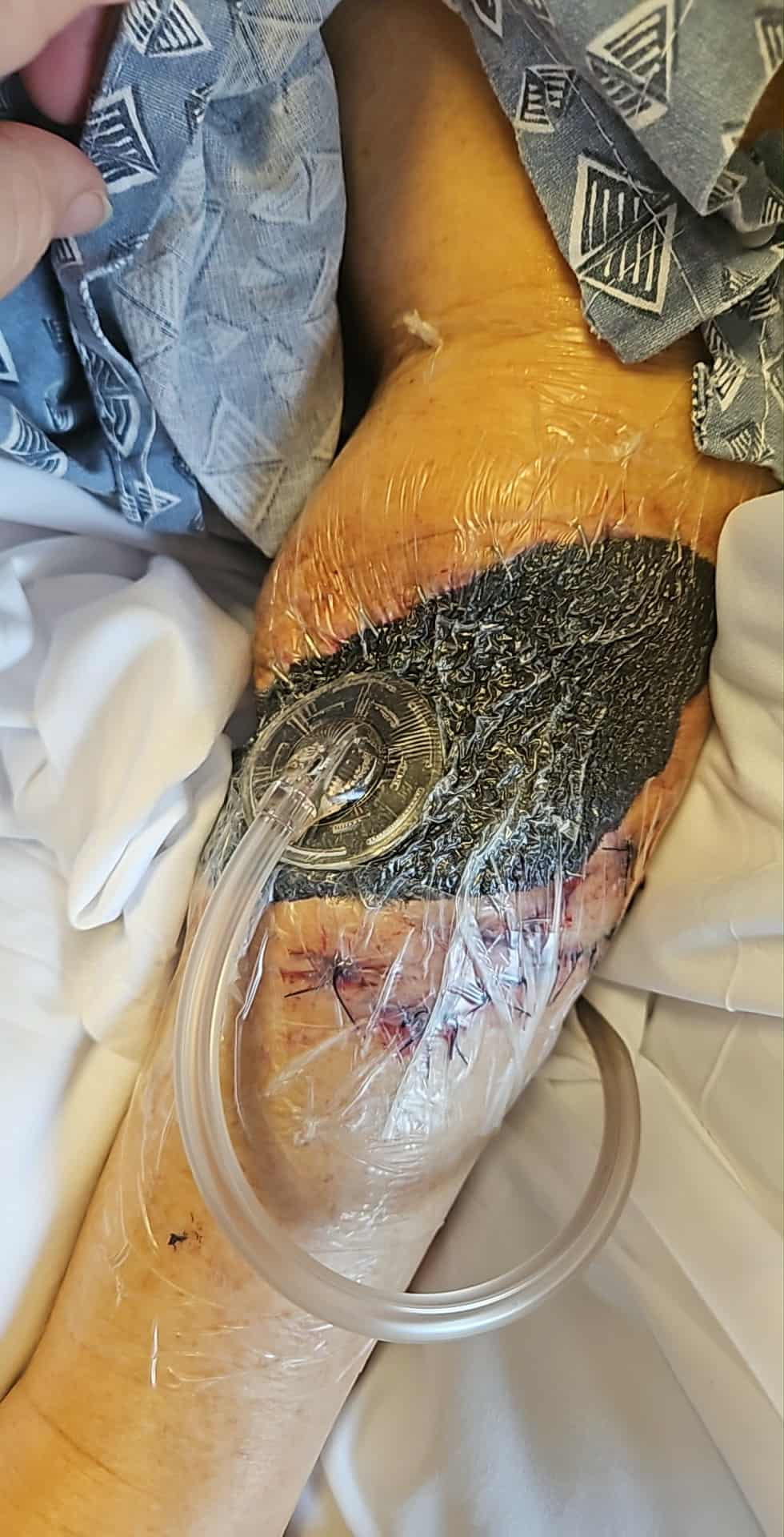 Help Jennifer Heal from Traumatic Dog Attack campaign photo, 2 of 5