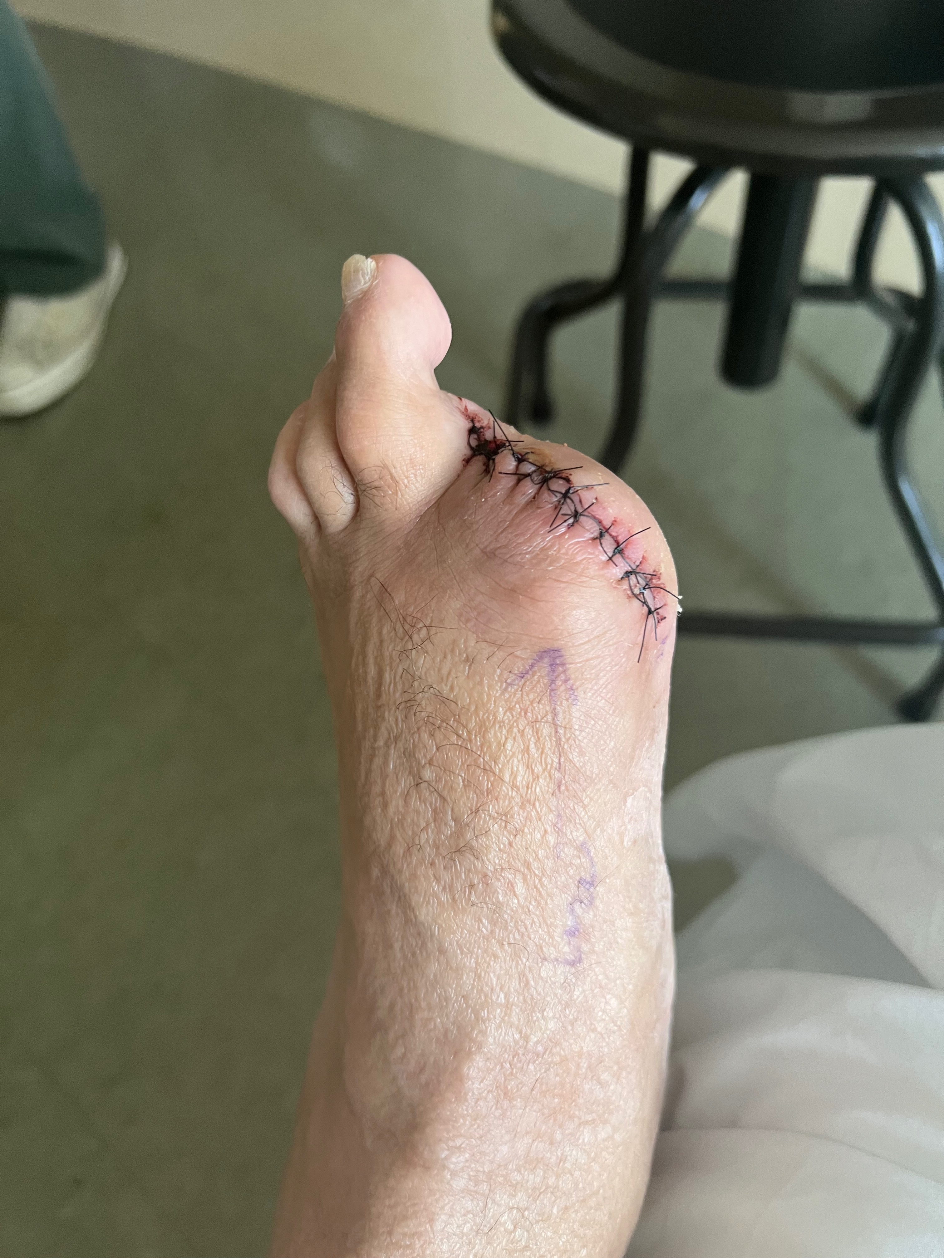 Urgent Help Needed for Toe Amputation and Recovery campaign photo, 4 of 7