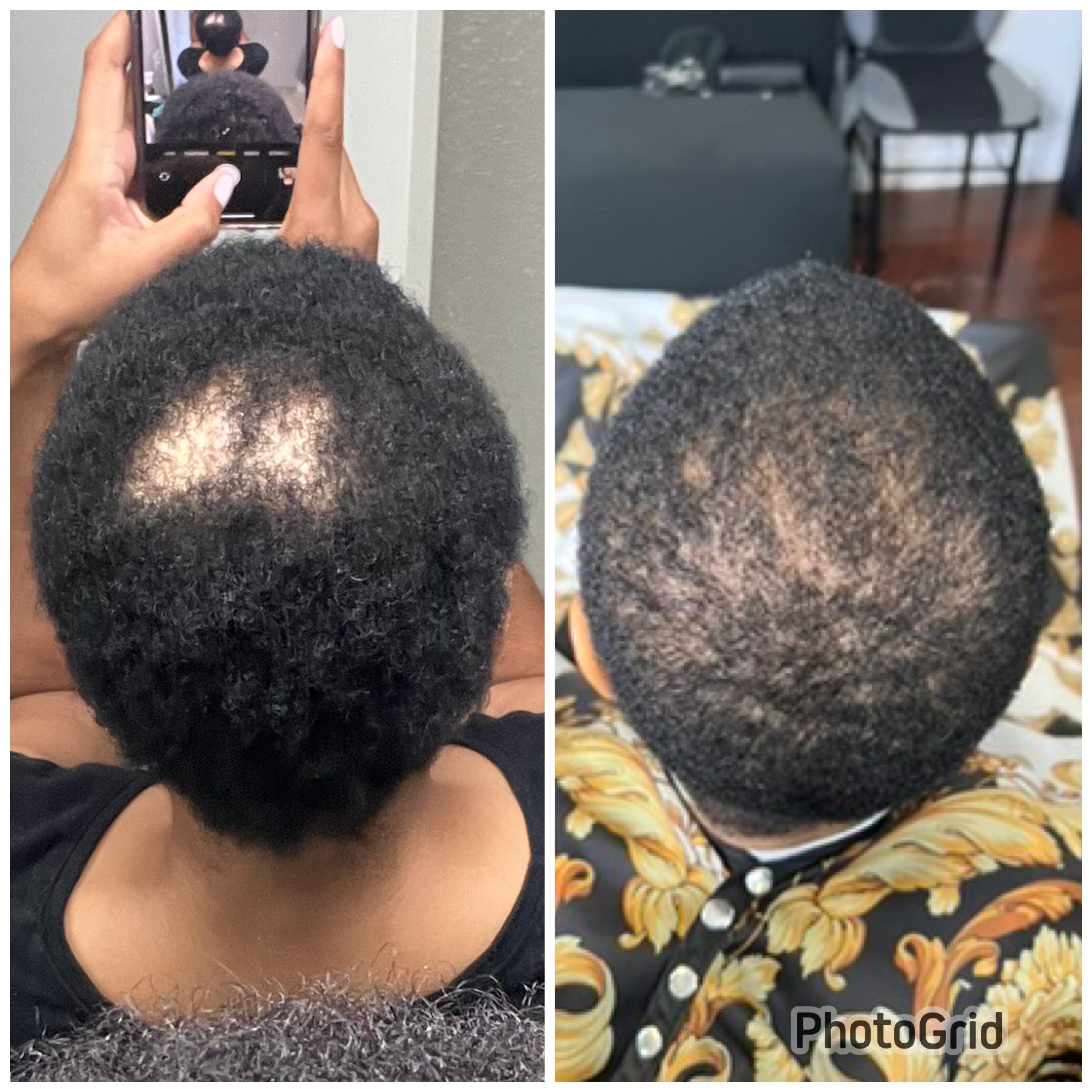 Help Support My Alopecia Journey campaign photo, 4 of 5