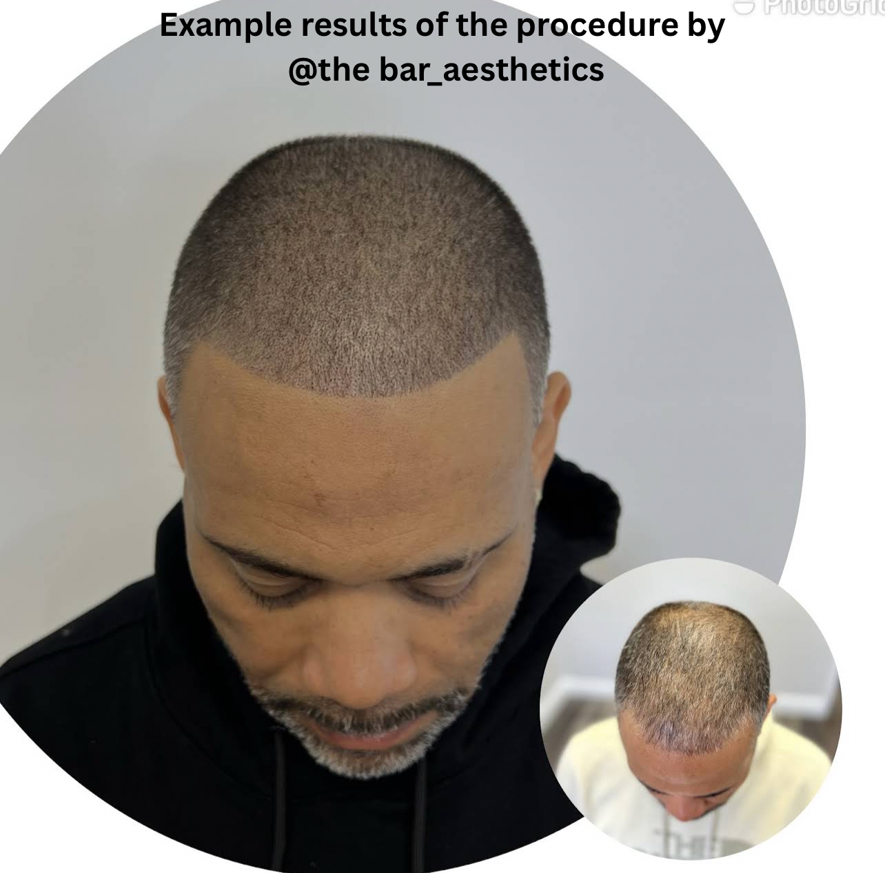 Help Support My Alopecia Journey campaign photo, 2 of 5