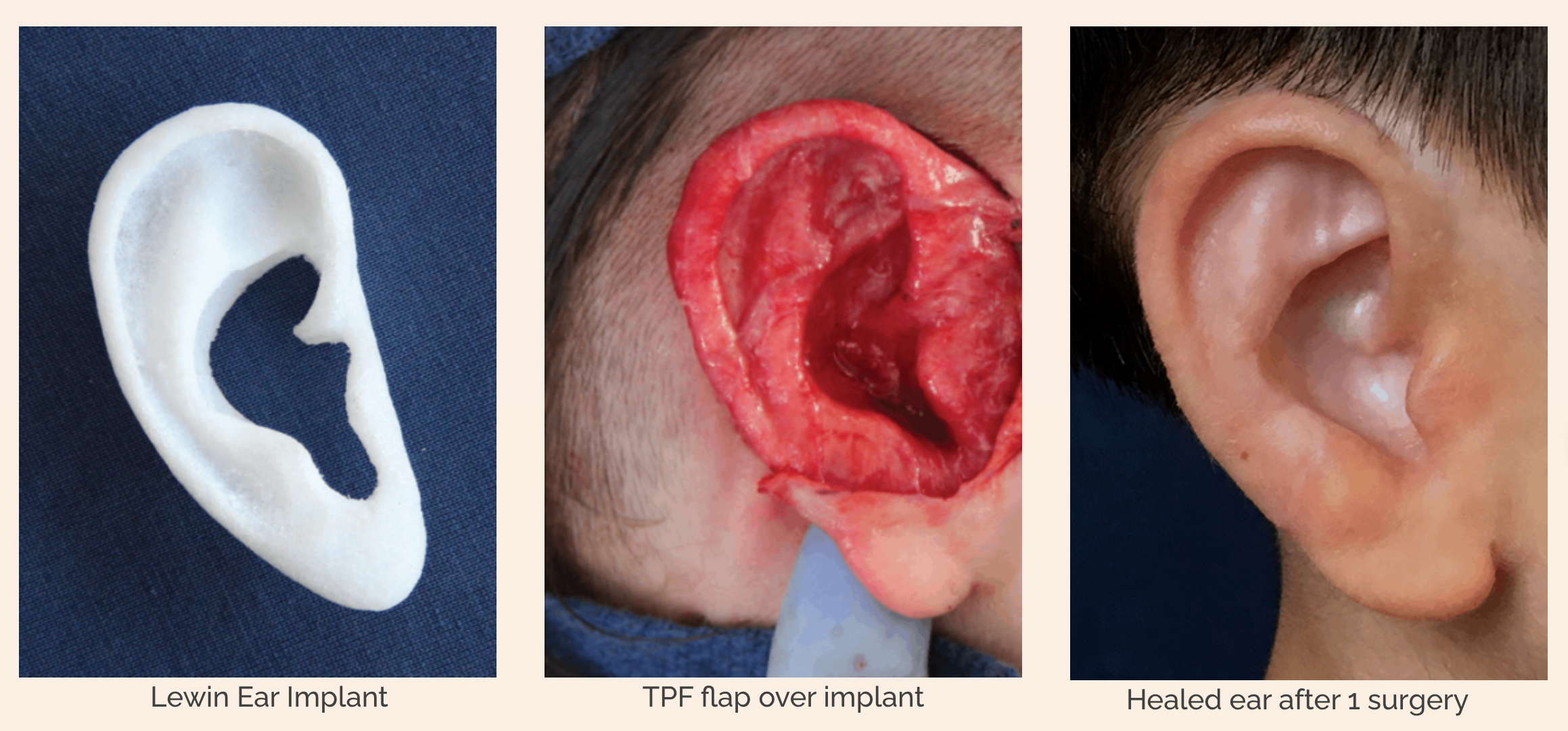 Emery's Microtia Surgery campaign photo, 6 of 8