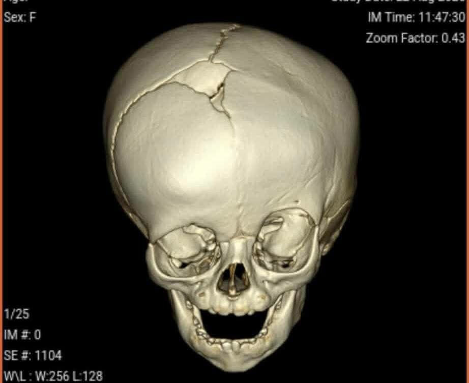 Donate for Daniella's Life-Changing Surgery campaign photo, 2 of 7