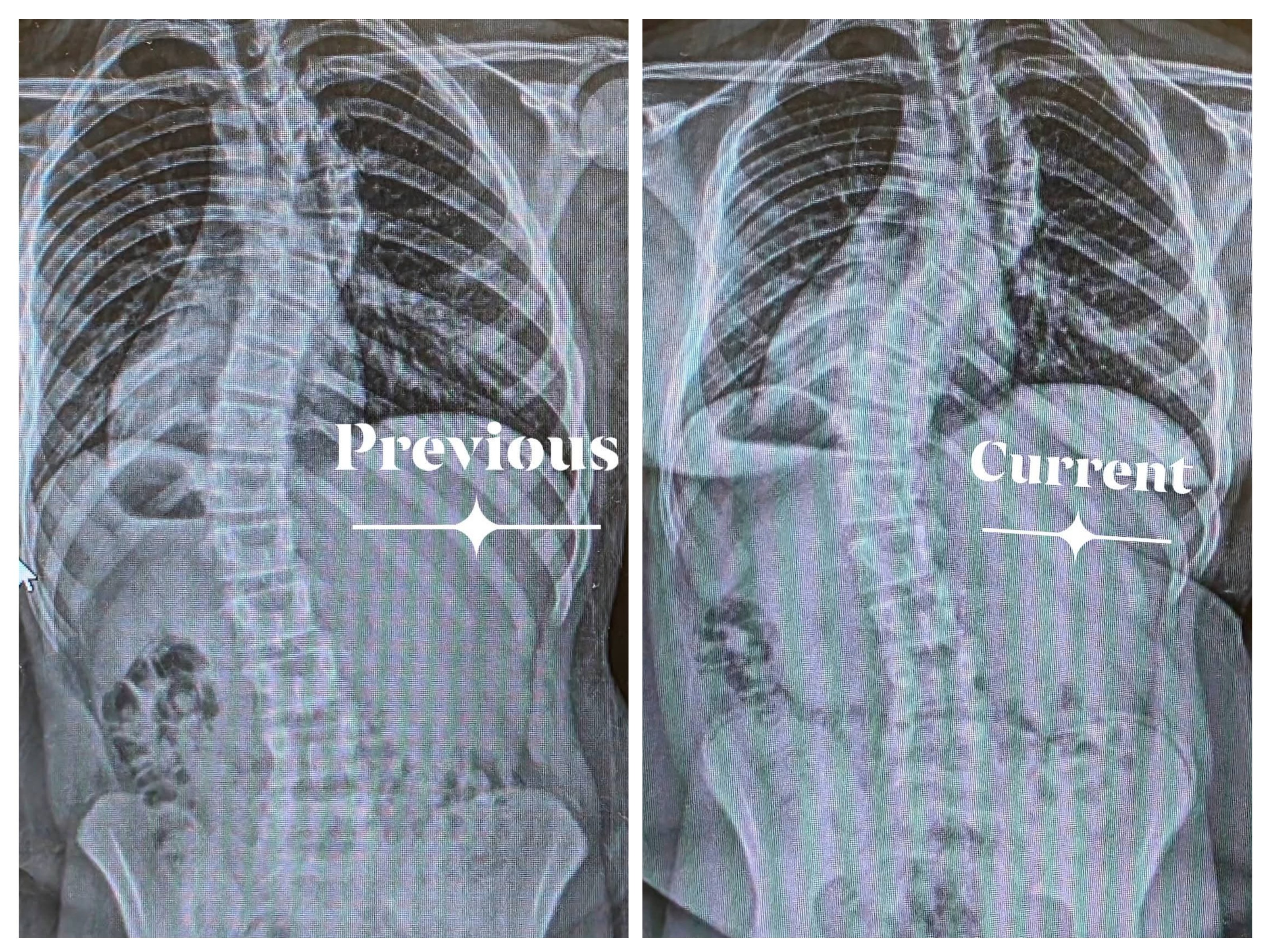 Support Riley's Recovery from Spinal Surgery campaign photo, 5 of 7