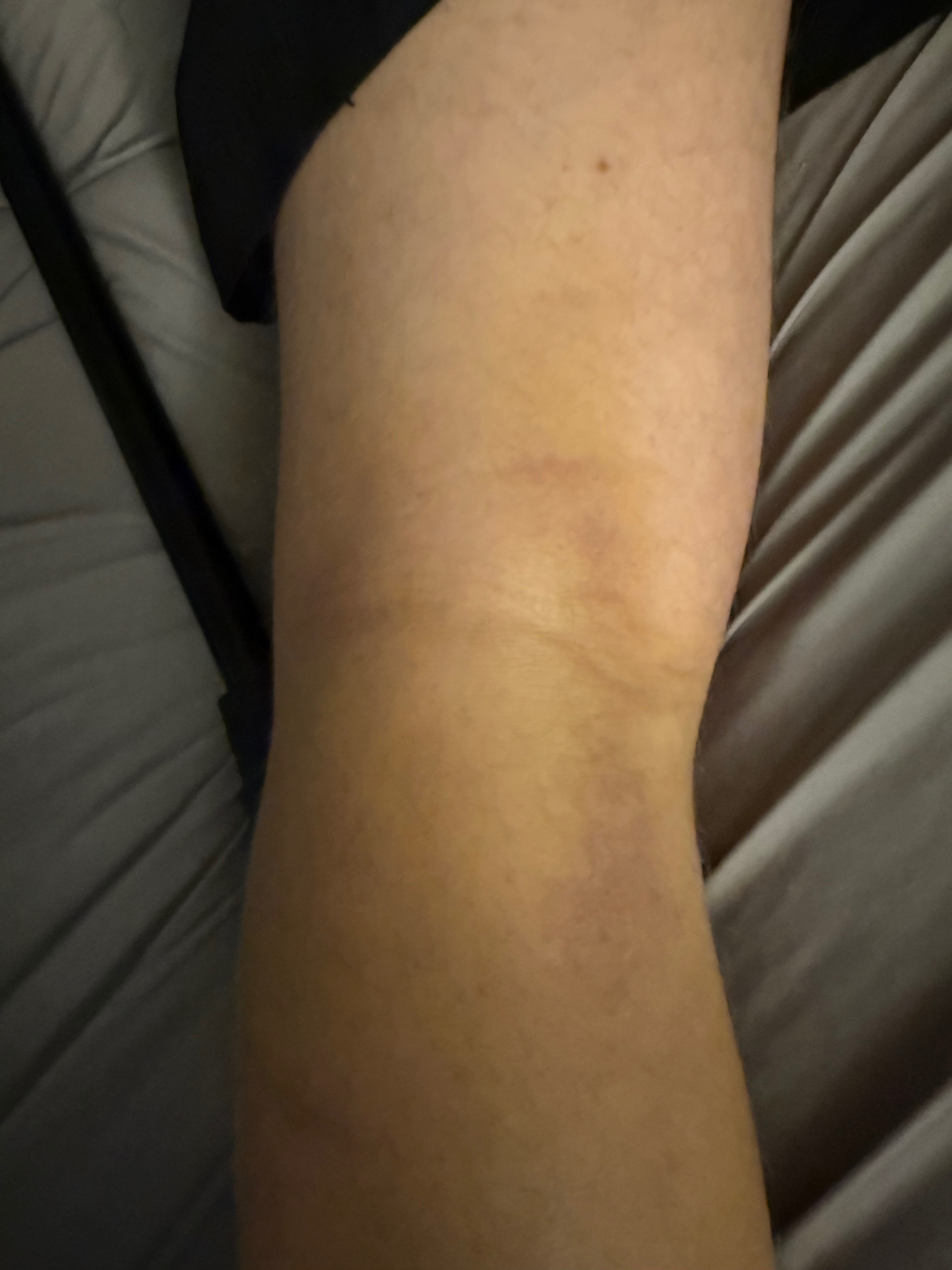 Support Tyler’s Knee Surgery Recovery campaign photo, 7 of 8