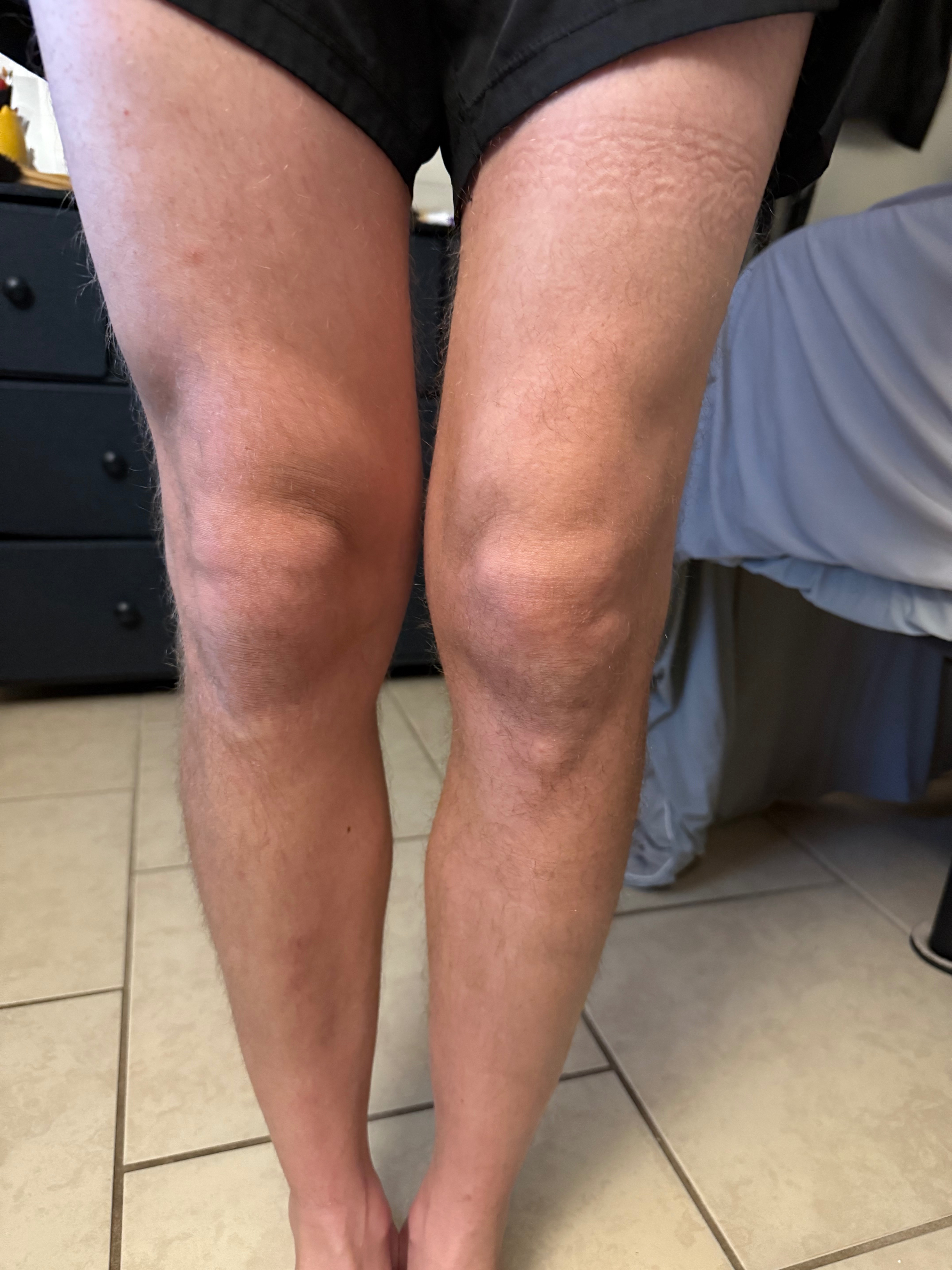 Support Tyler’s Knee Surgery Recovery campaign photo, 5 of 8