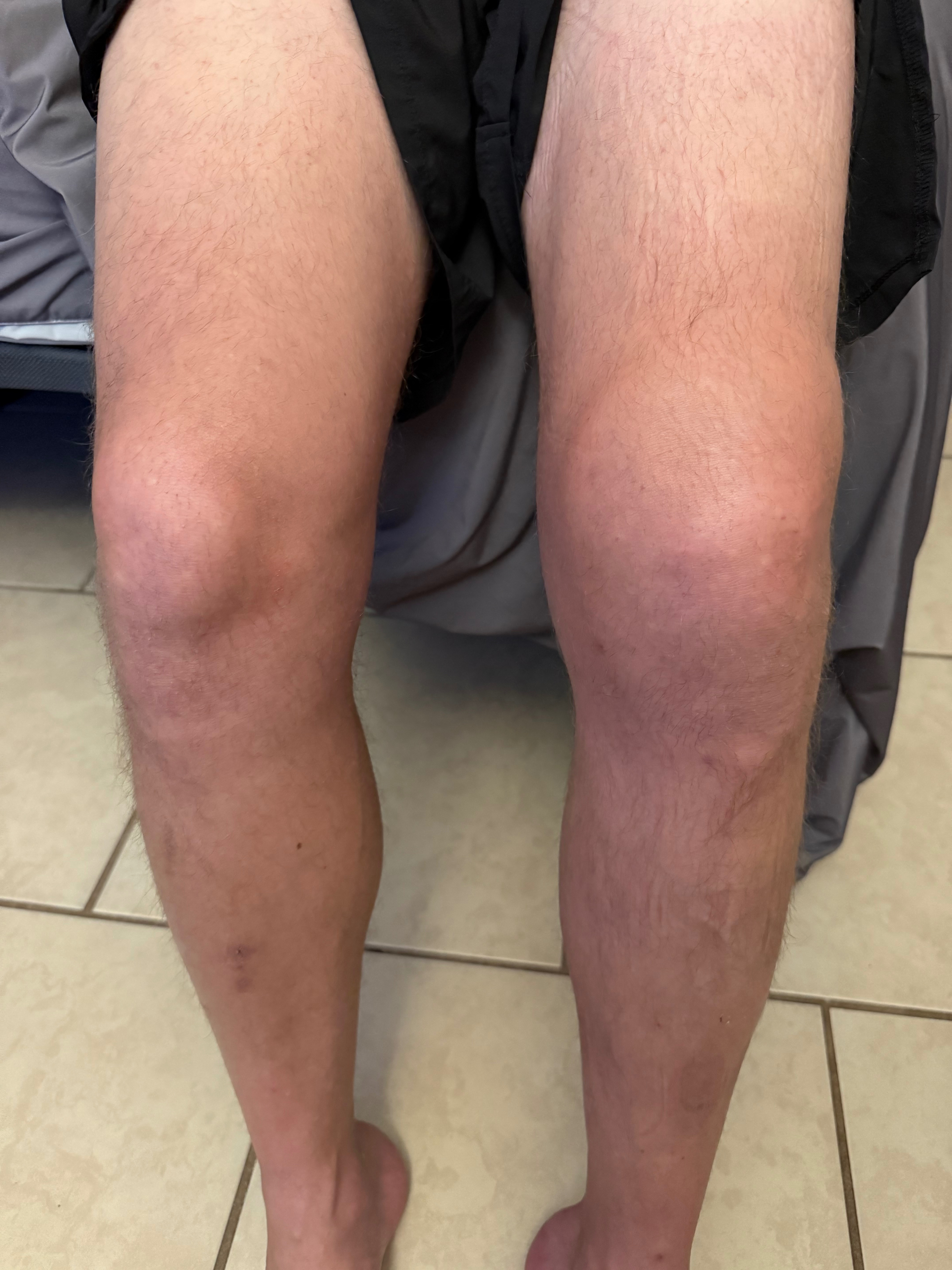 Support Tyler’s Knee Surgery Recovery campaign photo, 6 of 8