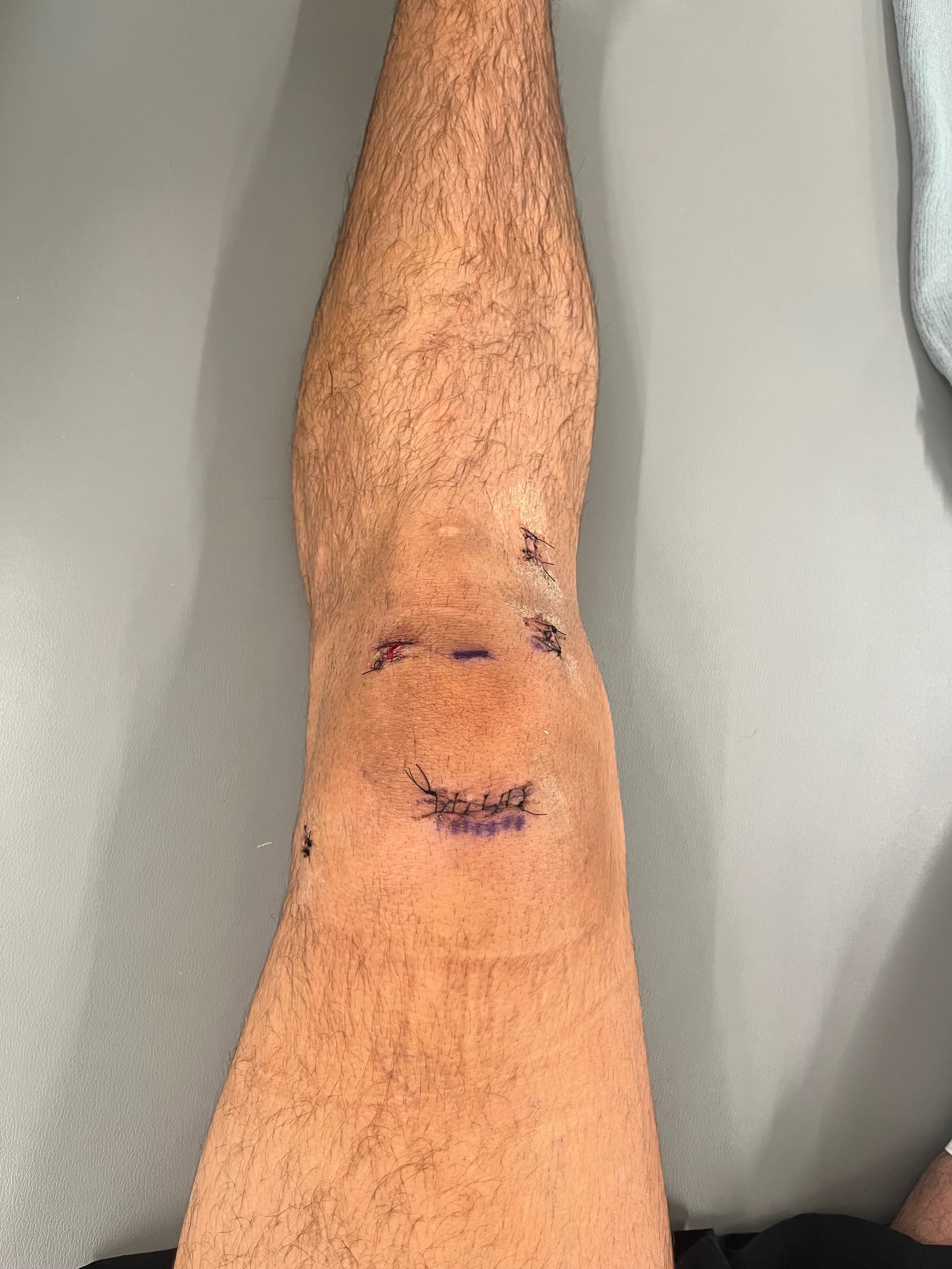 Bekher’s medical bills for ACL and meniscus surgery campaign photo, 7 of 8
