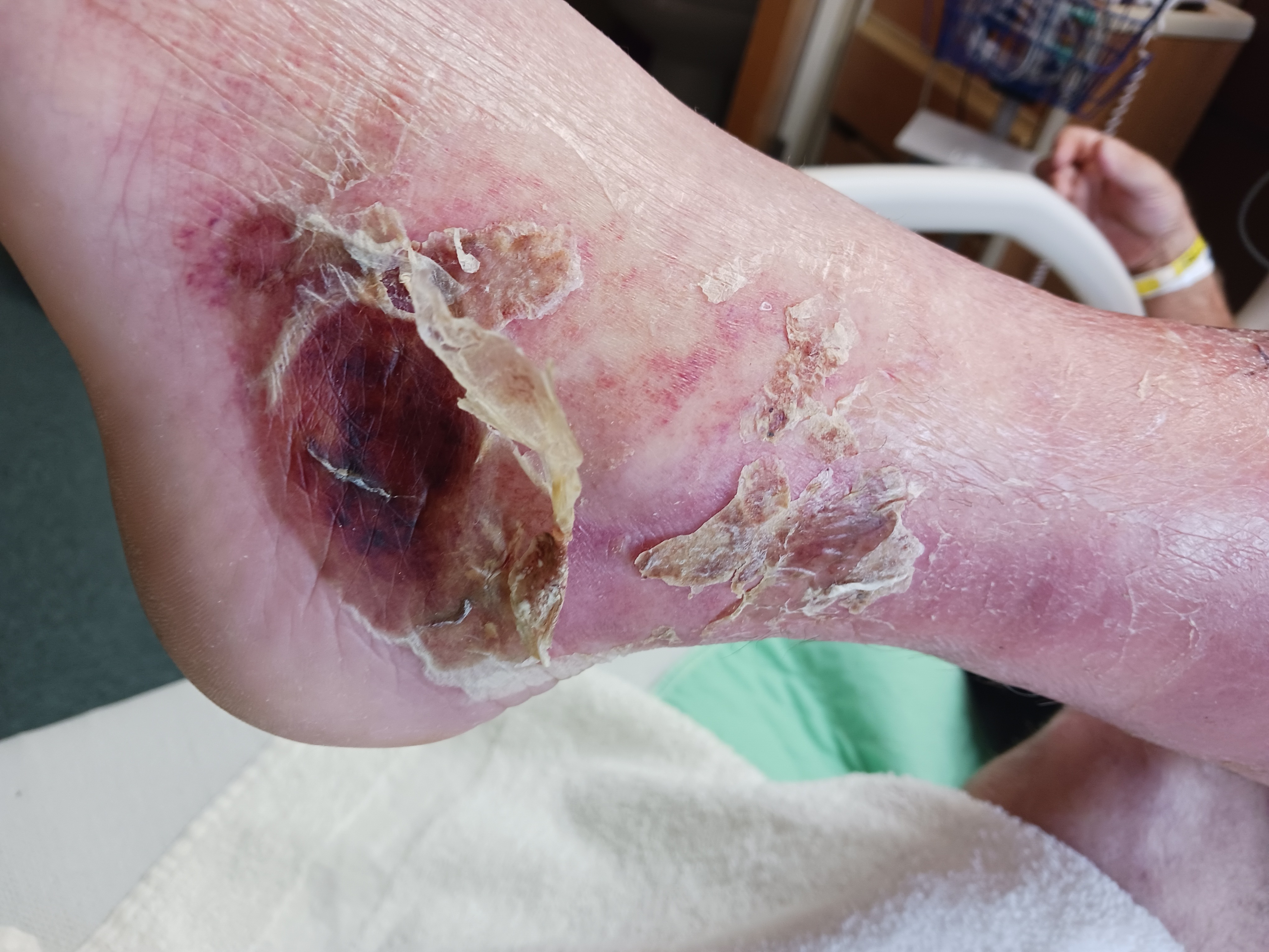 Help Cowboy Recover from Severe Infection campaign photo, 4 of 6