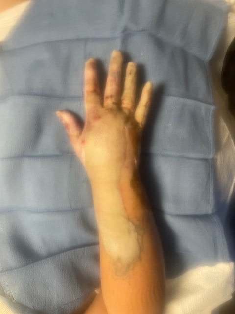 Support Casey's Recovery After Devastating Burns Feet & Hand campaign photo, 2 of 8
