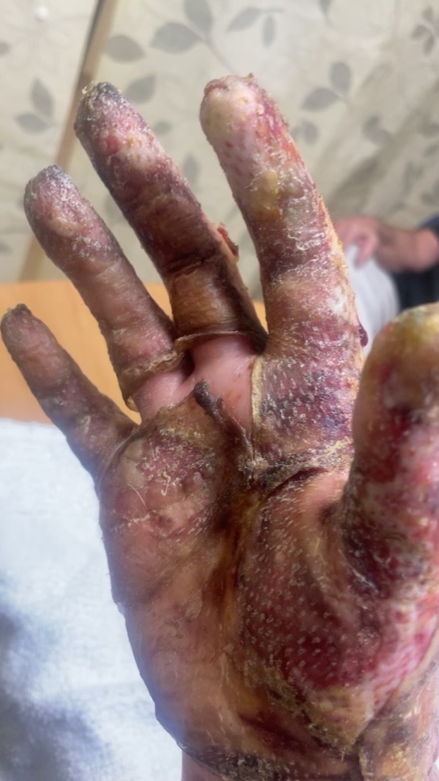 Support Casey's Recovery After Devastating Burns Feet & Hand campaign photo, 4 of 8