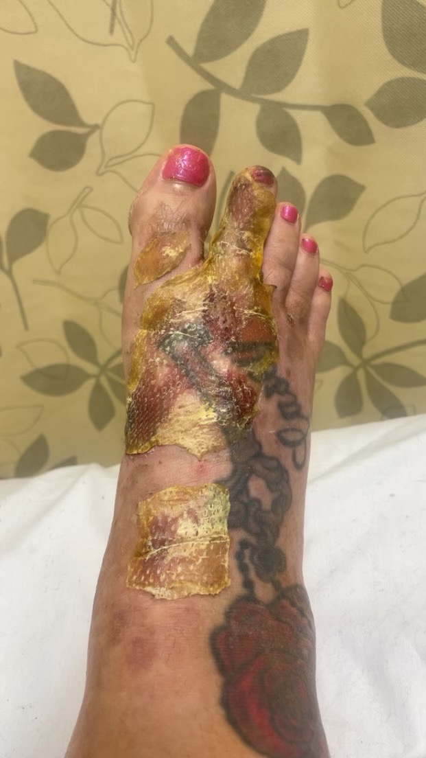 Support Casey's Recovery After Devastating Burns Feet & Hand campaign photo, 5 of 8