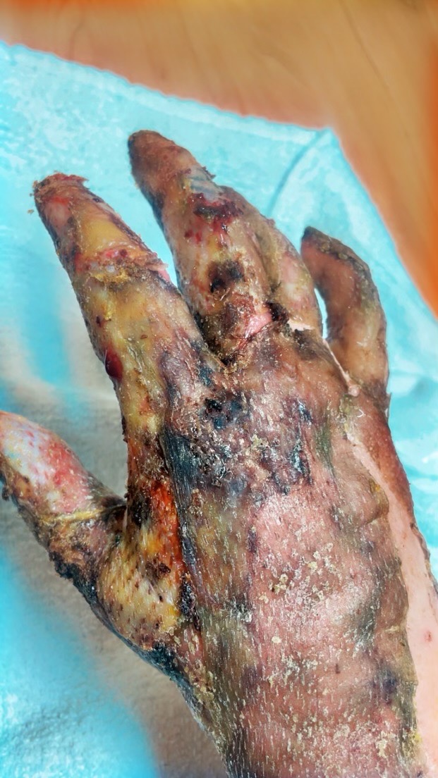 Support Casey's Recovery After Devastating Burns Feet & Hand campaign photo, 6 of 8